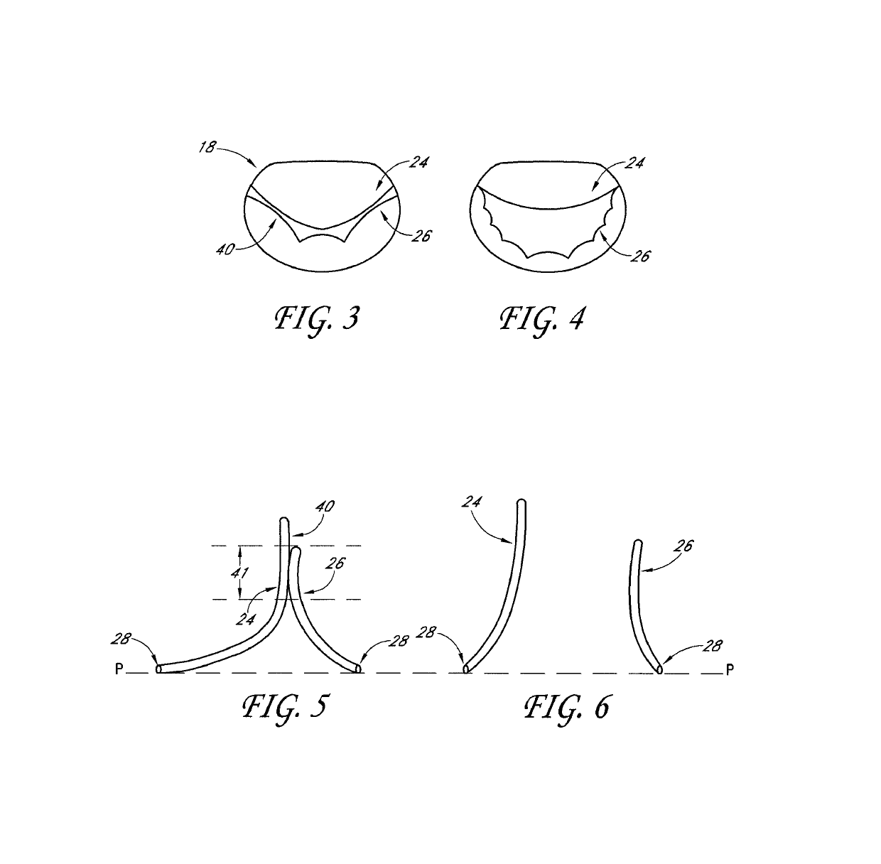 Transvalvular intraannular band for mitral valve repair