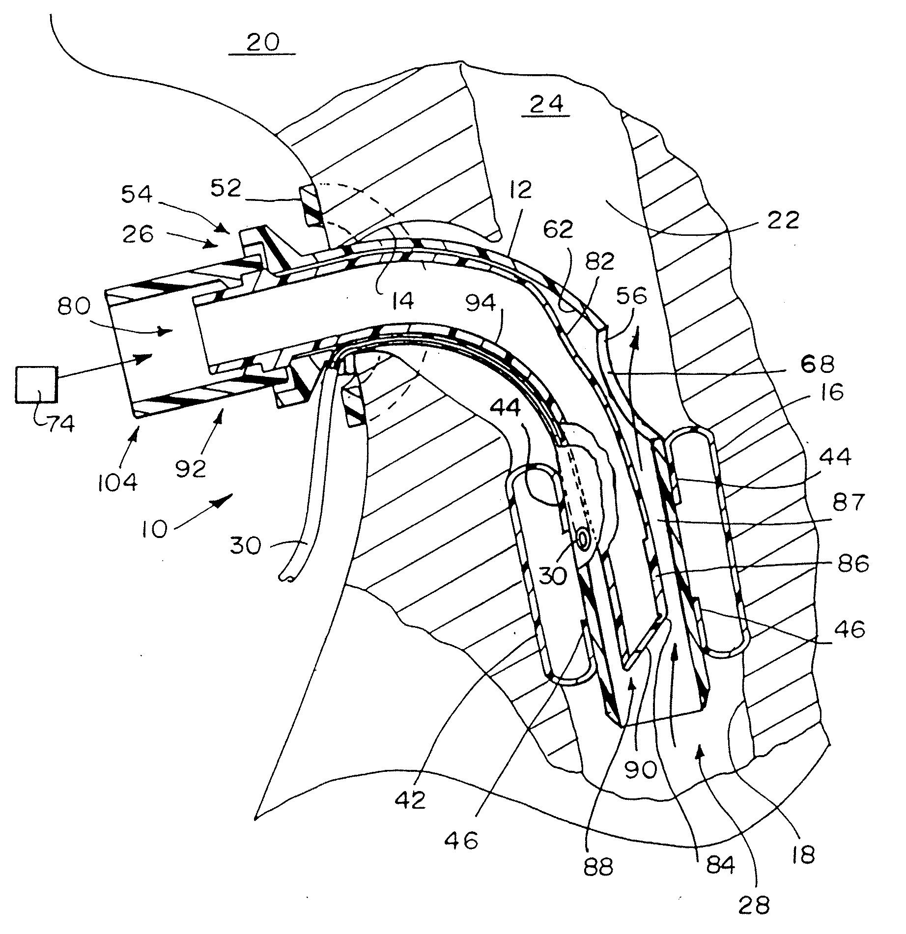 Valved Fenestrated Tracheotomy Tube Having Outer and Inner Cannulae