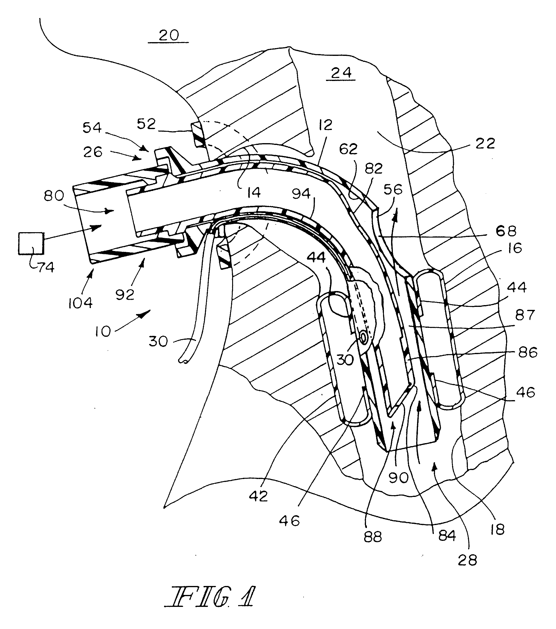 Valved Fenestrated Tracheotomy Tube Having Outer and Inner Cannulae