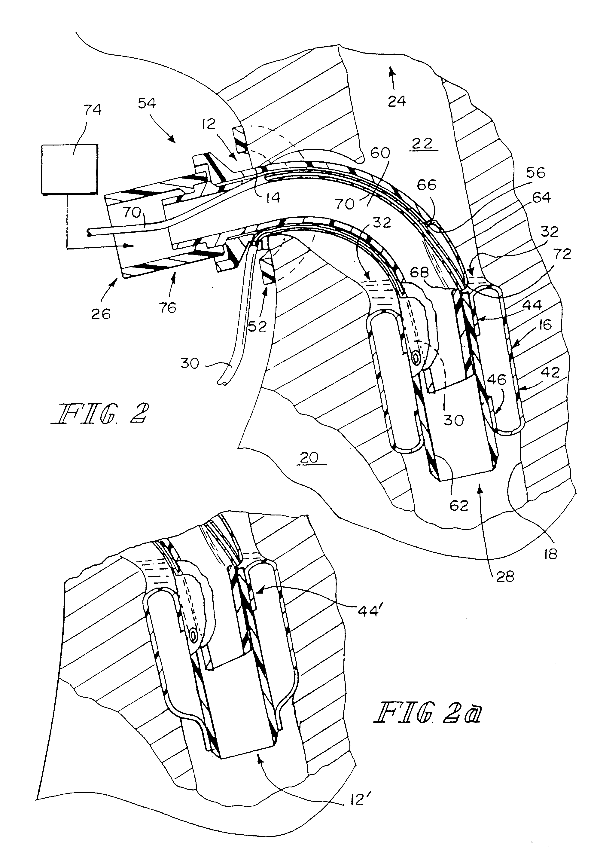 Valved Fenestrated Tracheotomy Tube Having Outer and Inner Cannulae