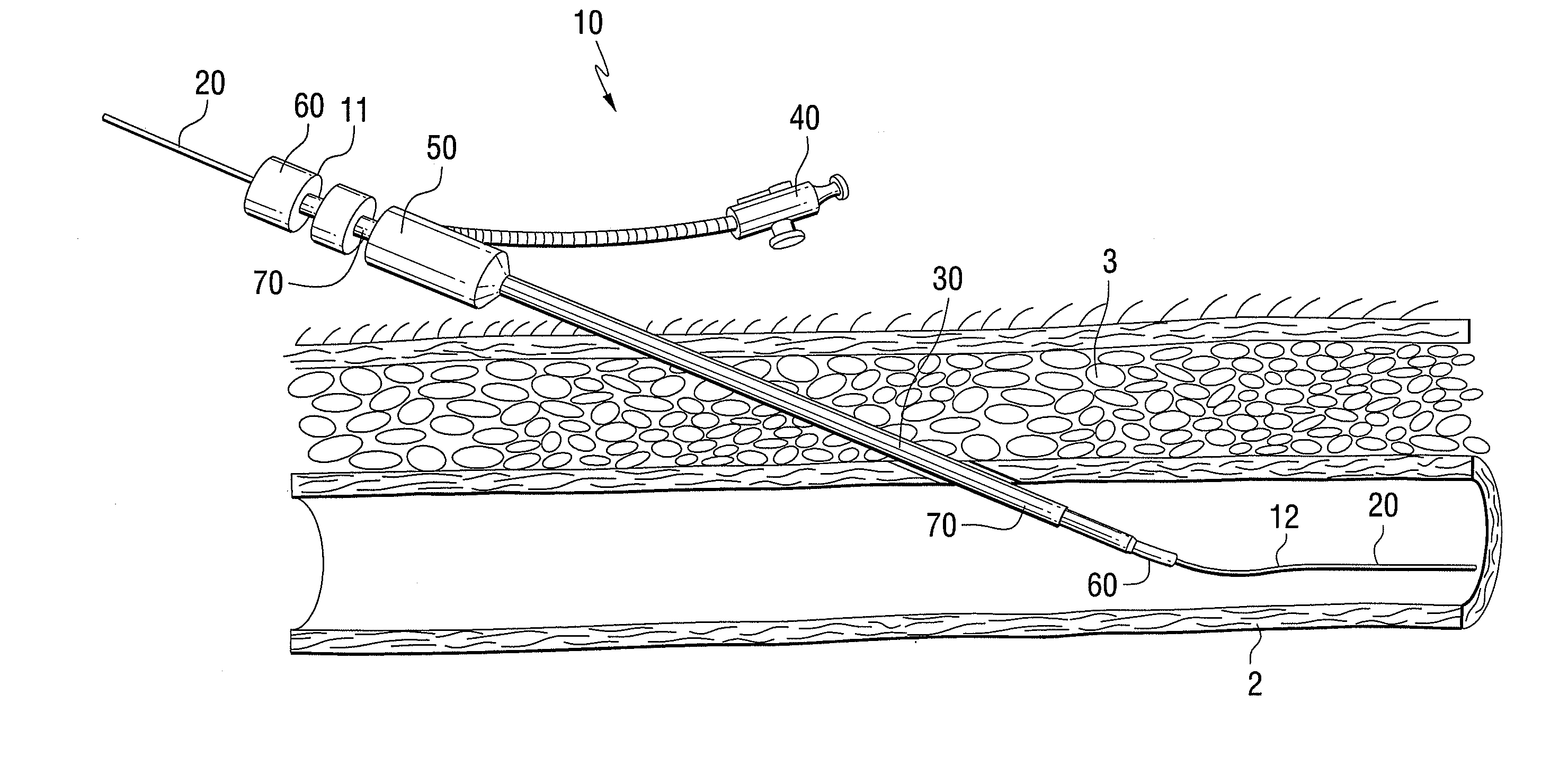 Vascular access device and method