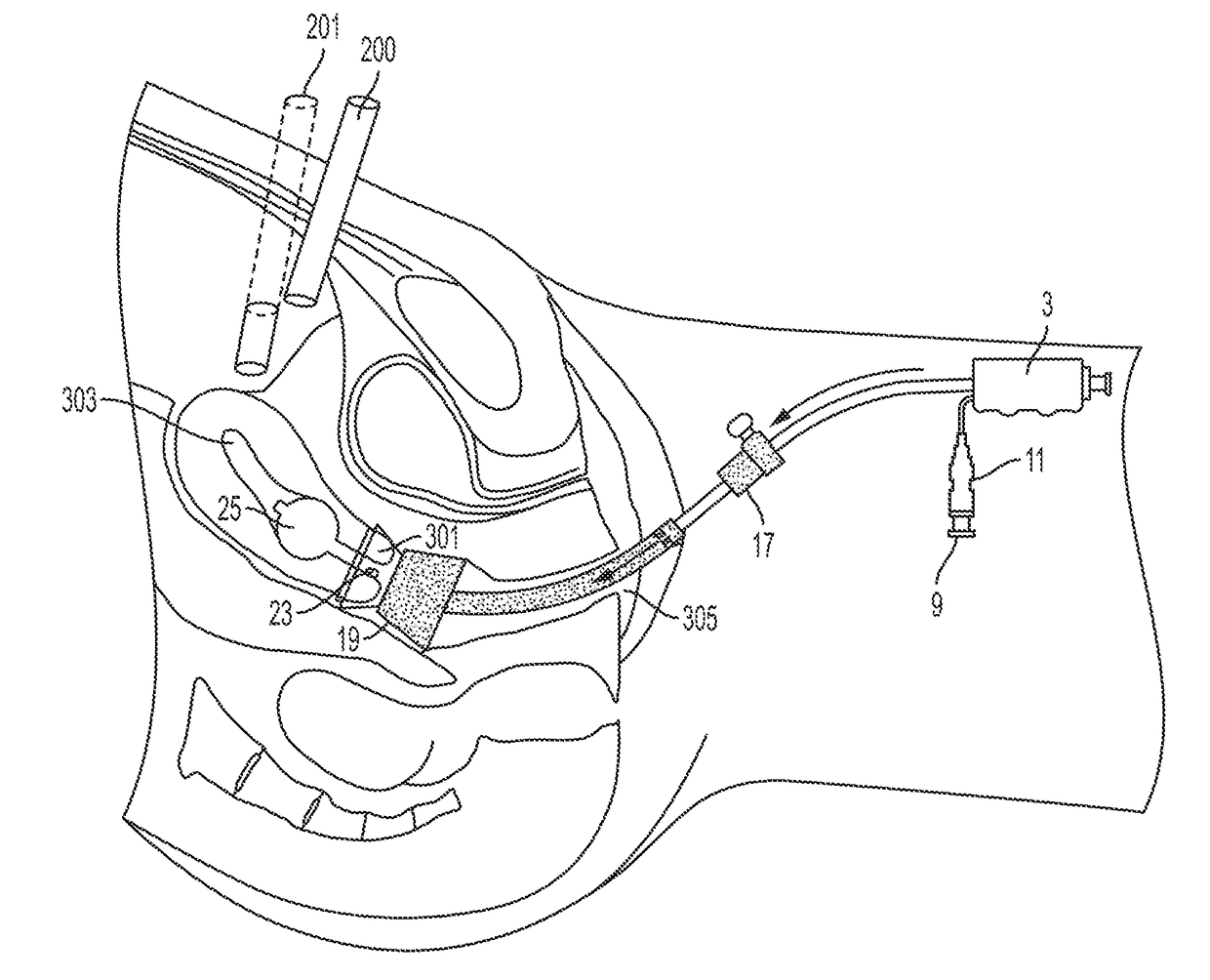 Uterine Manipulator