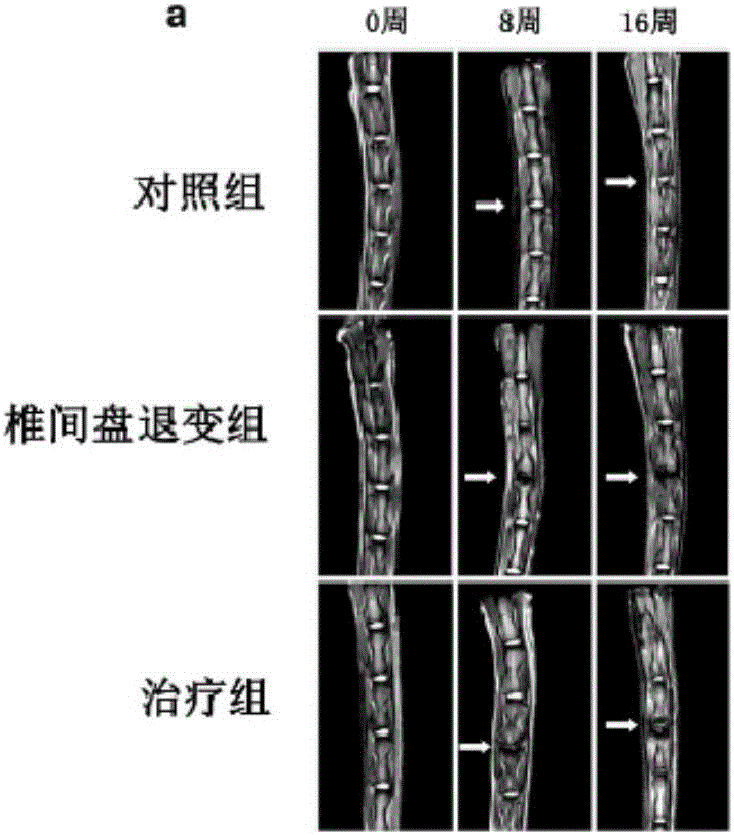 Application of dimethyldiguanide as active component in medicine for treating disc degeneration disease