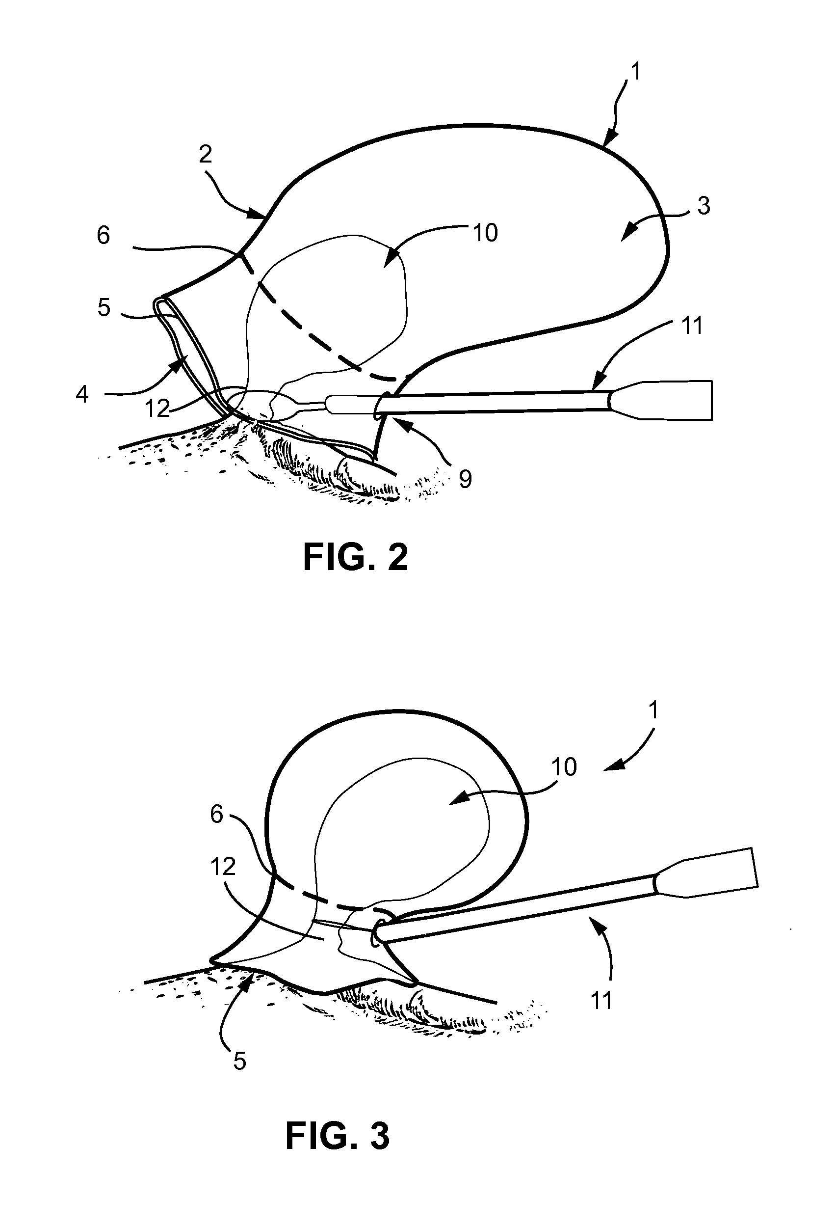 Method of amputating and morcellating a uterus