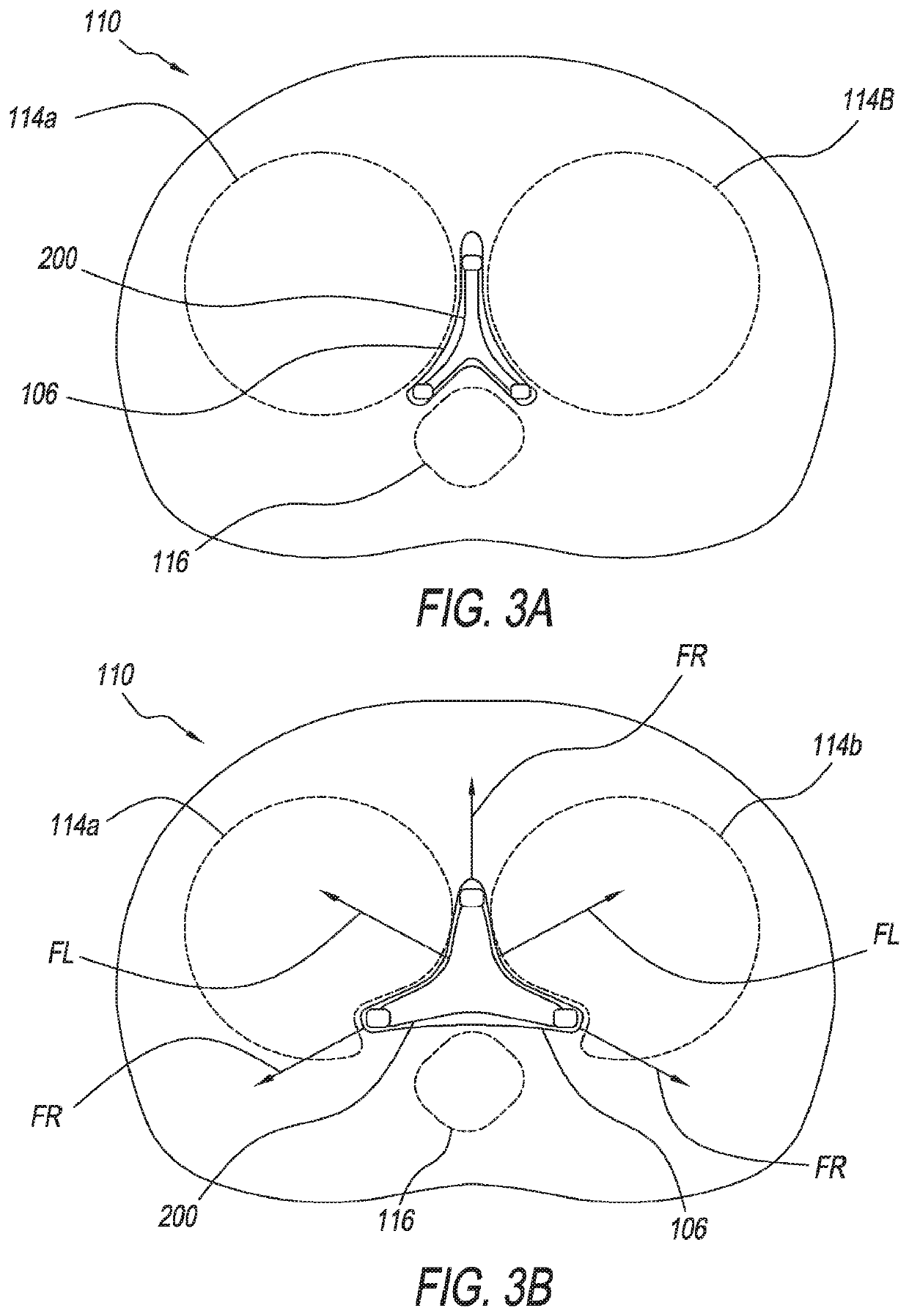 Retracting or/and supporting periurethral tissue