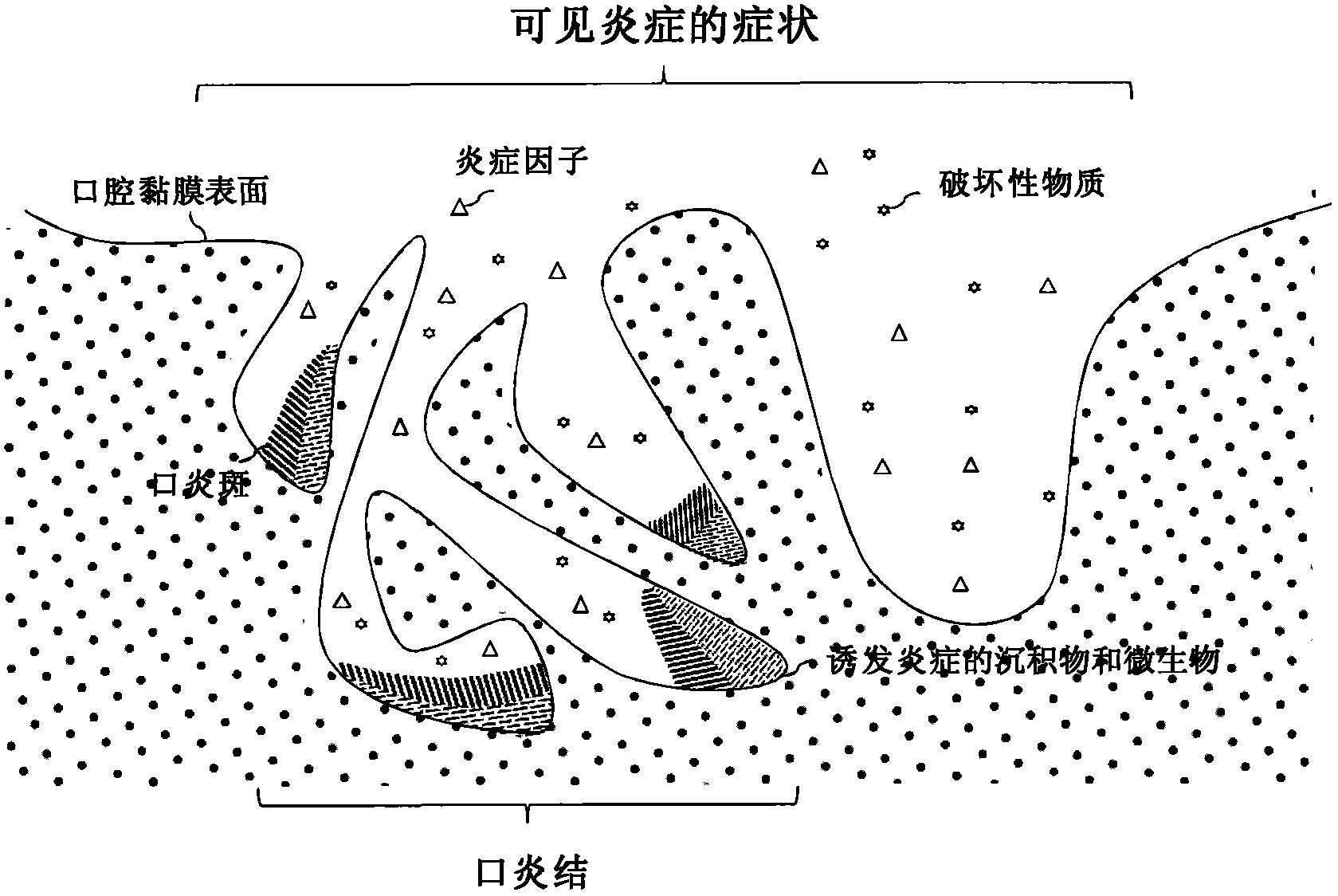 Solution product and combined product alleviating or removing stomatitis nodules and stomatitis spots, and application thereof