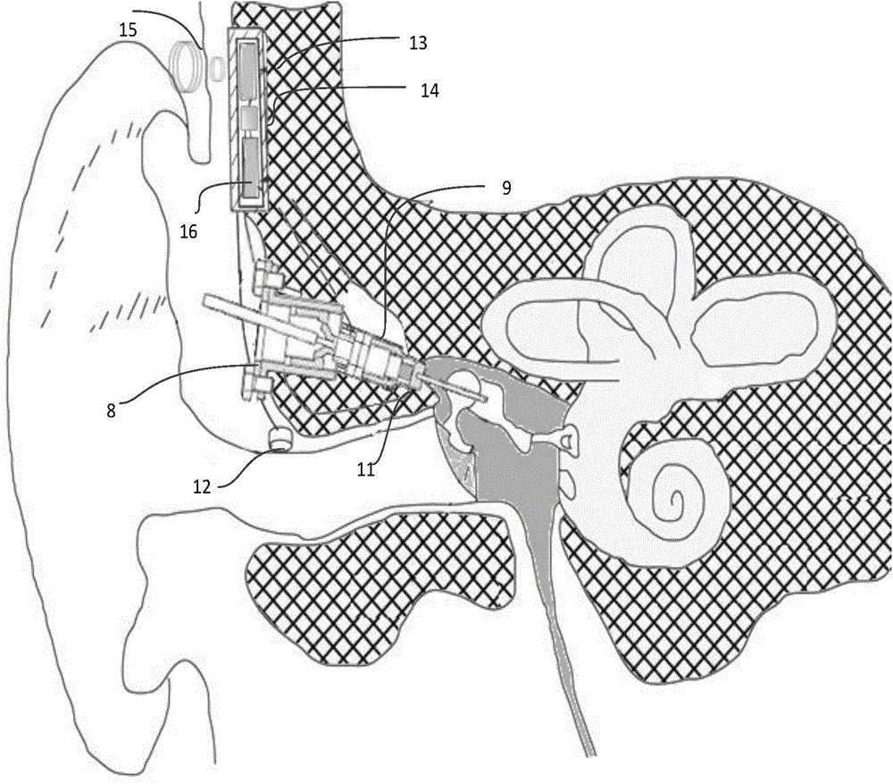 Implant-type hearing-aid device wirelessly powered and capable of prompting electric quantity