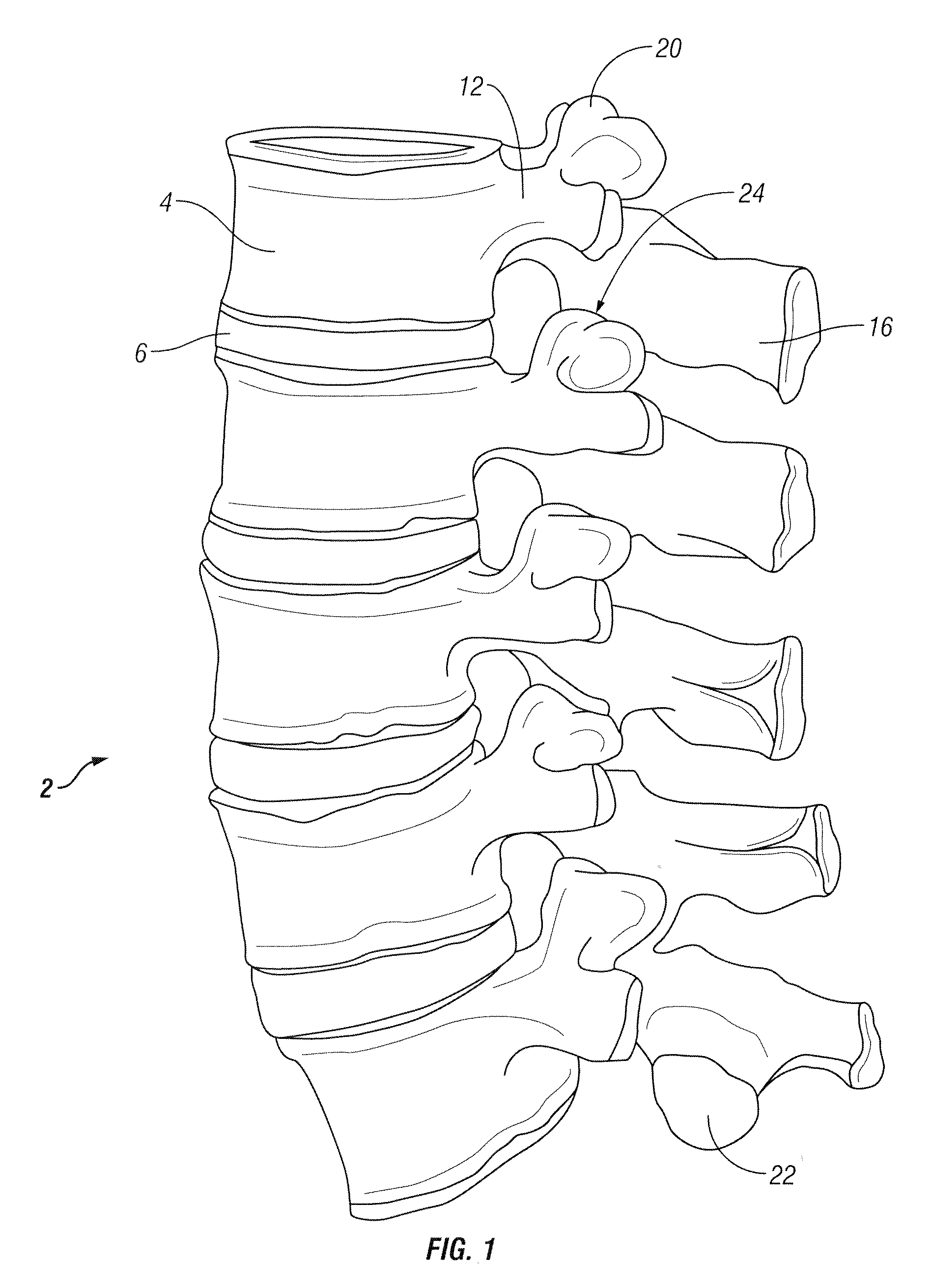 Method for accessing a spinal facet joint