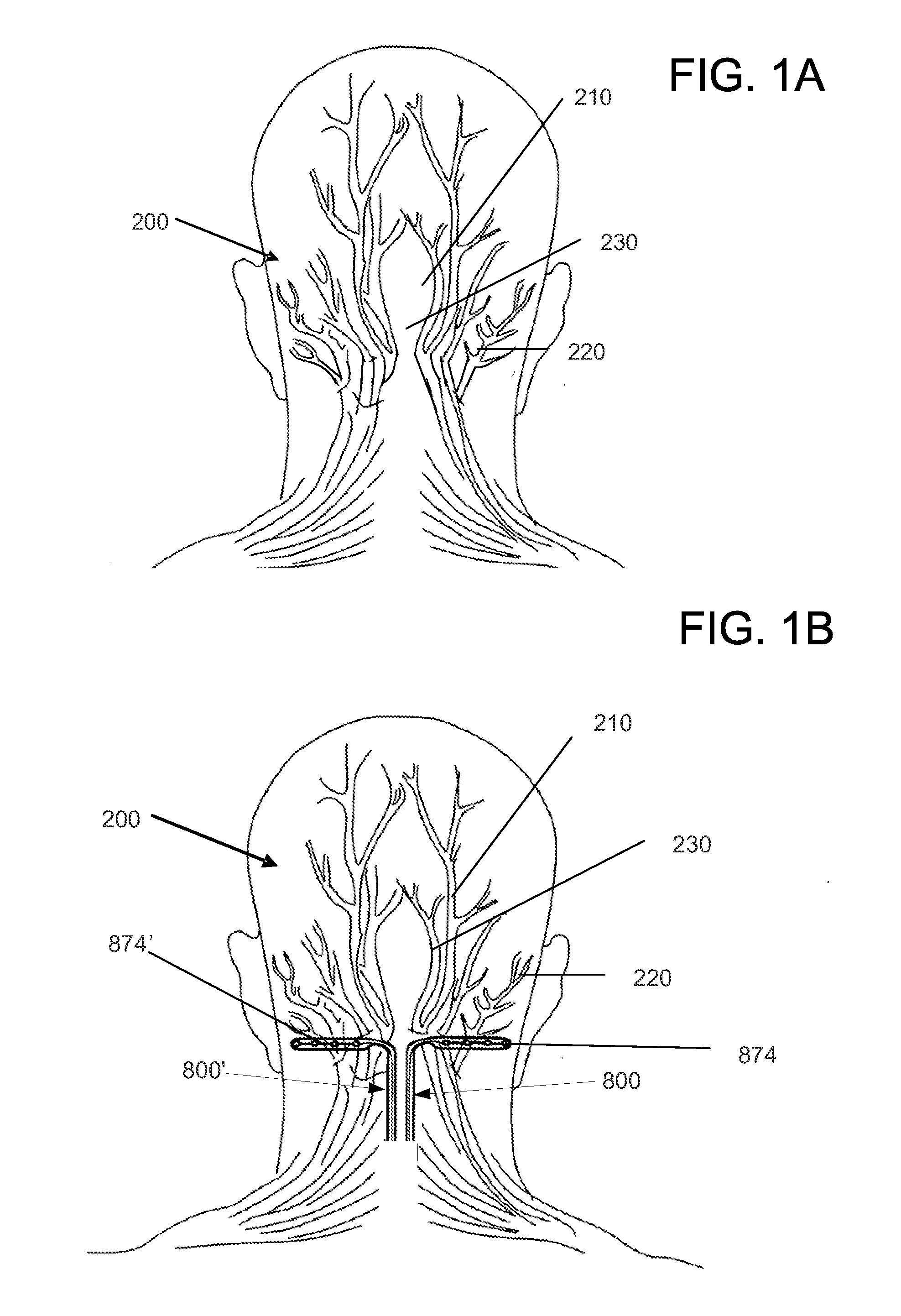 Anchor assembly for use in occipital nerve stimulation