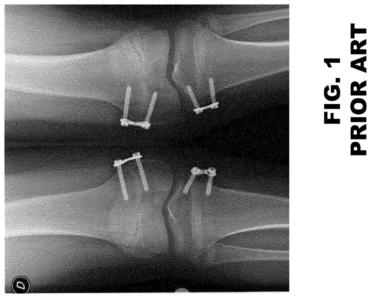 Inner fixation device for the treatment of a limb, in particular the femur distal portion or tibia proximal portion