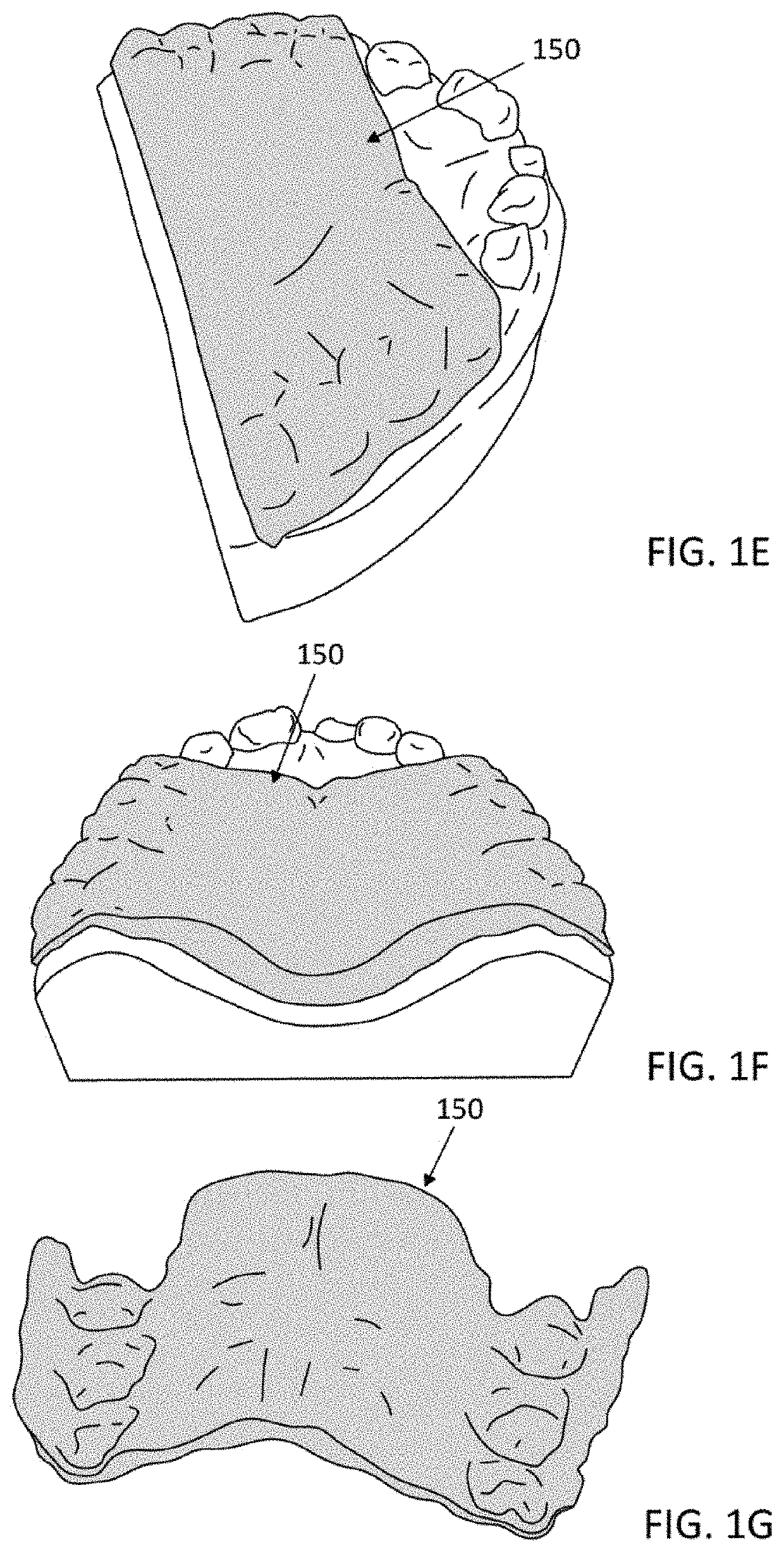 Palatal expanders and methods of expanding a palate