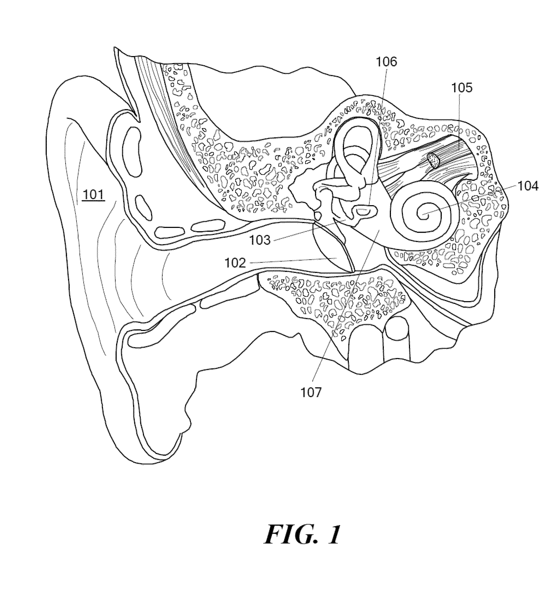 Electromagnetic Bone Conduction Hearing Device