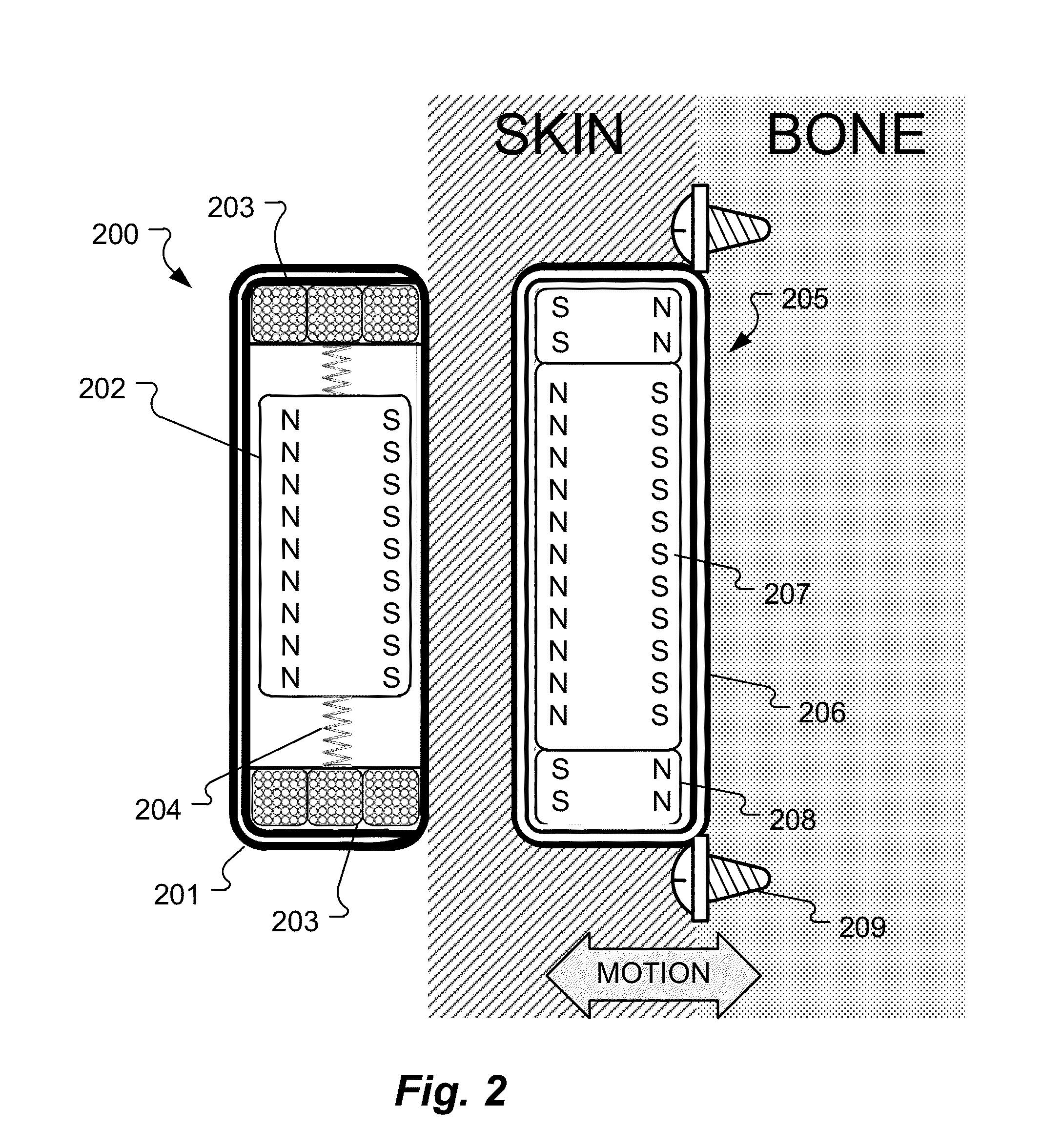 Electromagnetic Bone Conduction Hearing Device