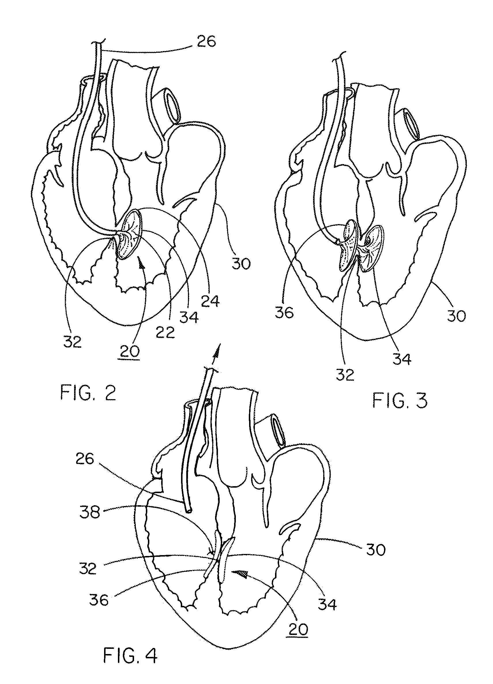 Implantable product with improved aqueous interface characteristics and method for making and using same