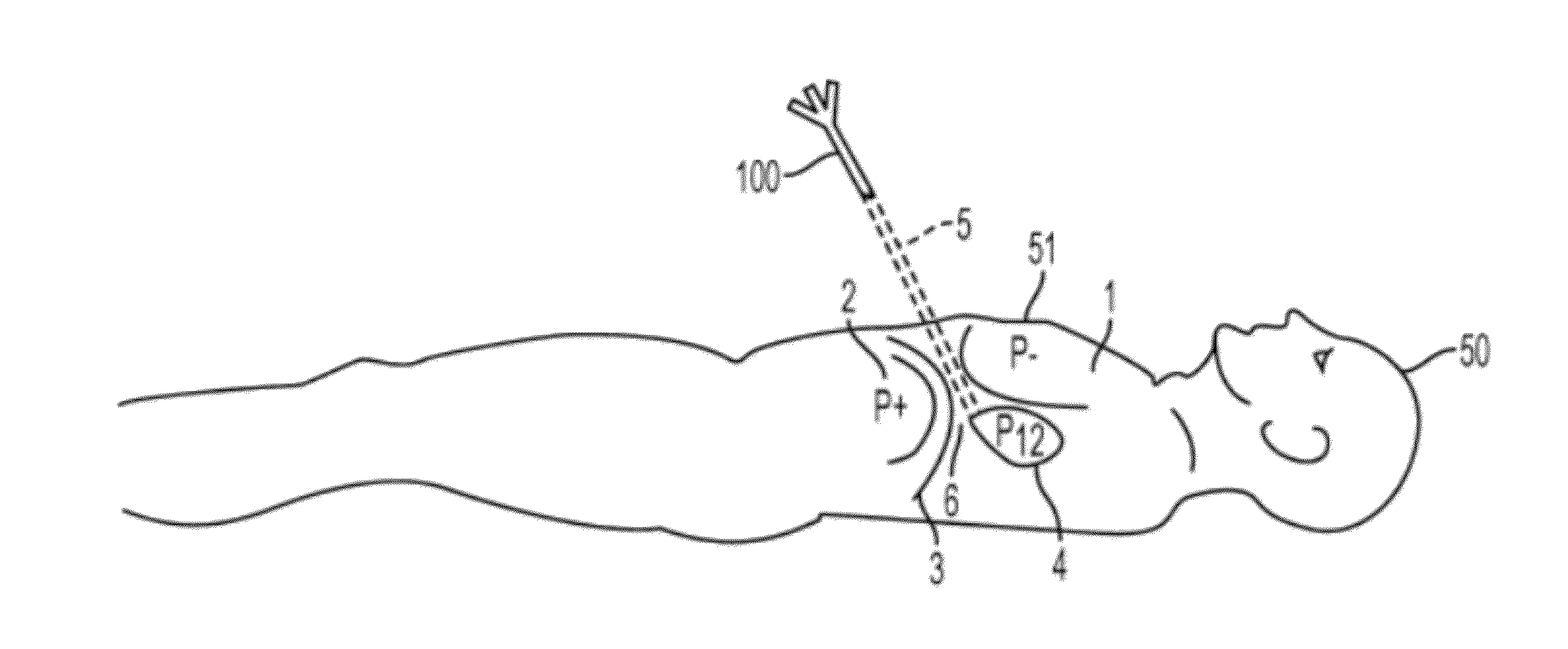 Systems and methods for determining location of an access needle in a subject