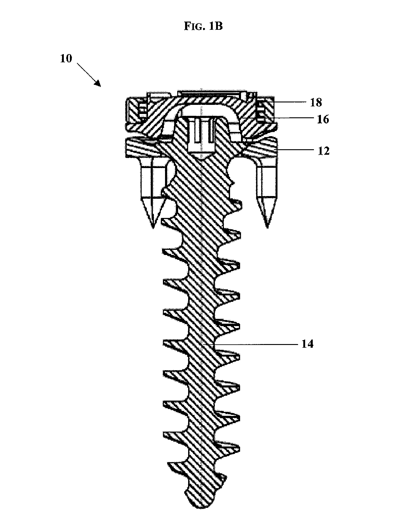 Low profile spinal tethering systems