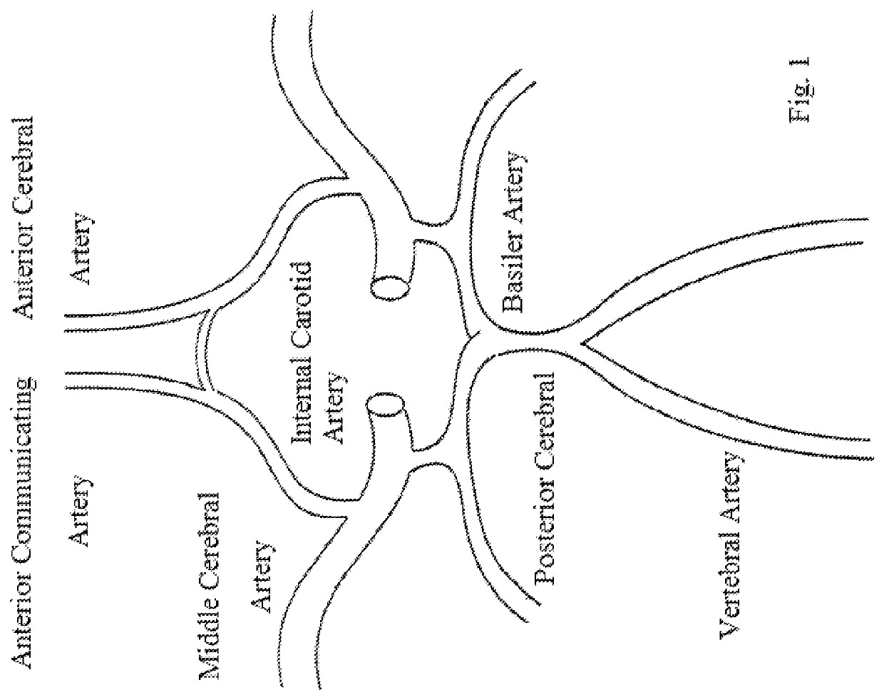 Filterless Aspiration, Irrigating, Macerating, Rotating Microcatheter and Method of Use