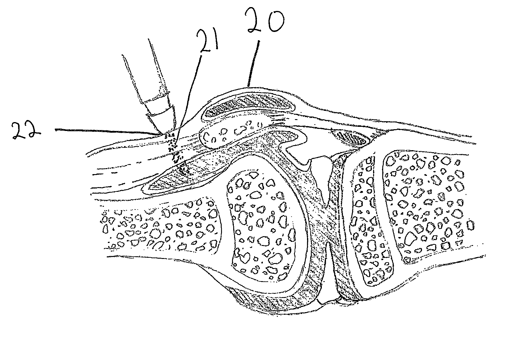 Device and method for treating musculo-skeletal injury and pain by application of laser light therapy