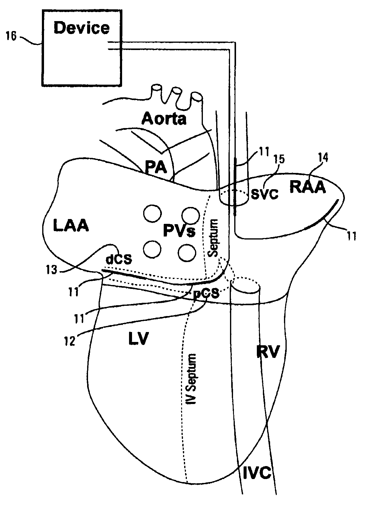 Method and device for three-stage atrial cardioversion therapy