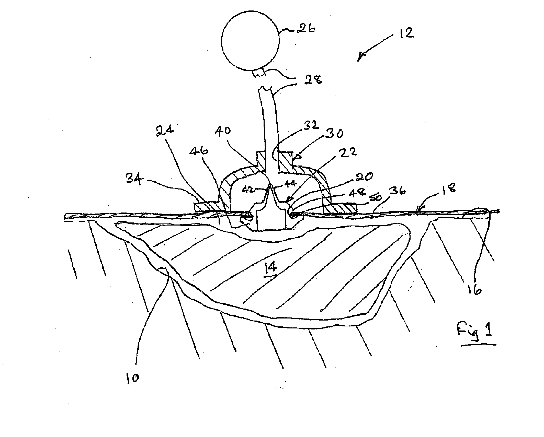 Vacuum assisted wound dressing