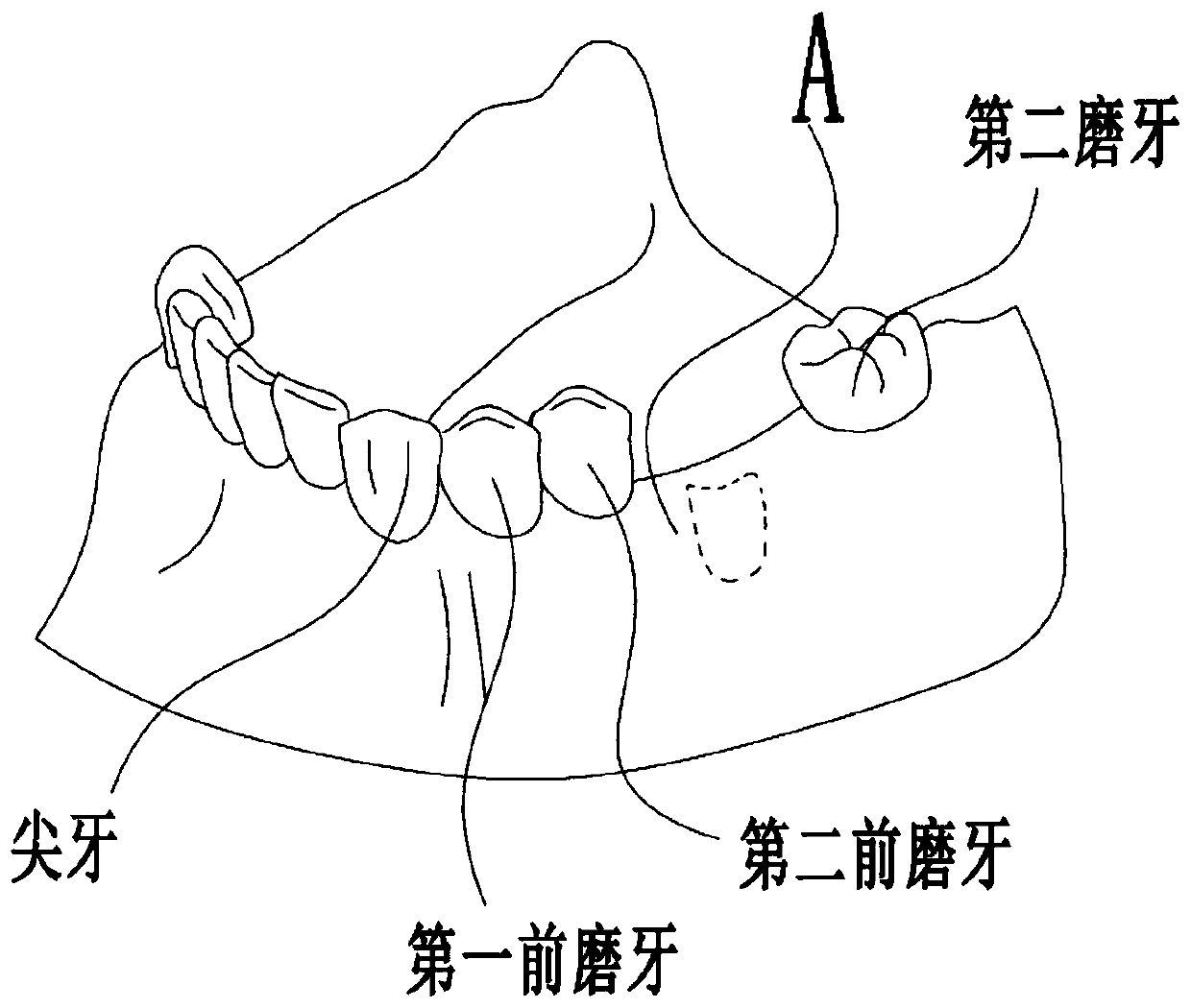 A positioning device and method for two-stage oral implant surgery