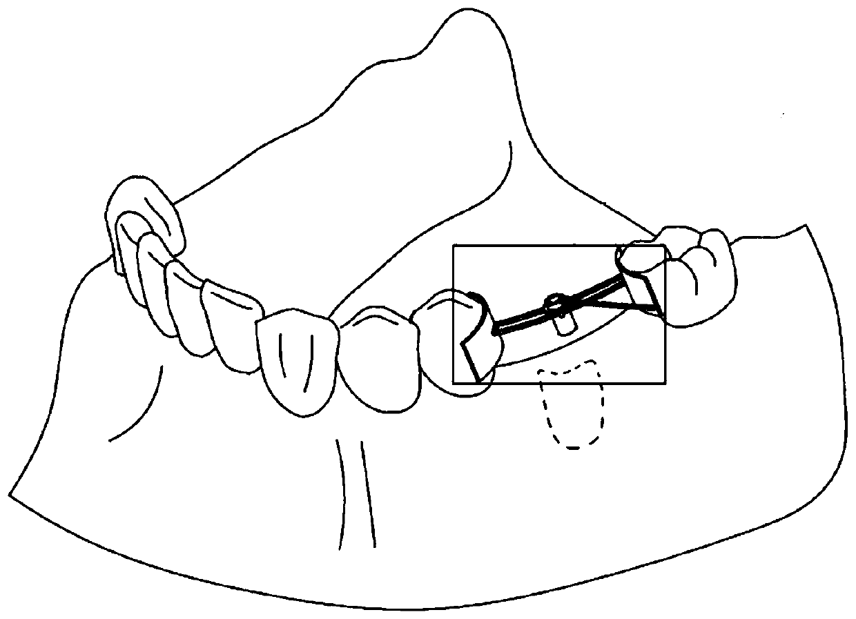 A positioning device and method for two-stage oral implant surgery