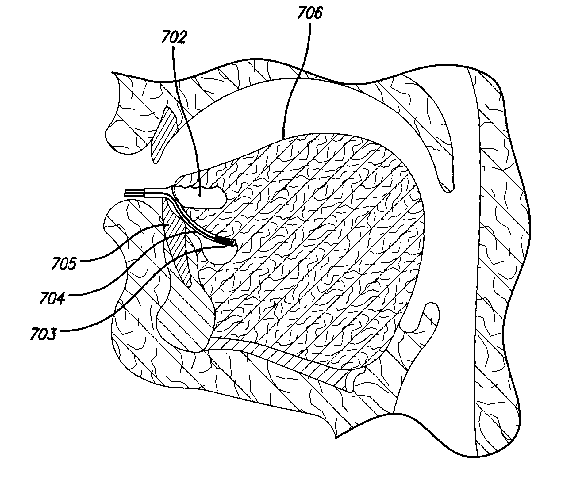 Apparatus and method for treating obstructive sleep apnea