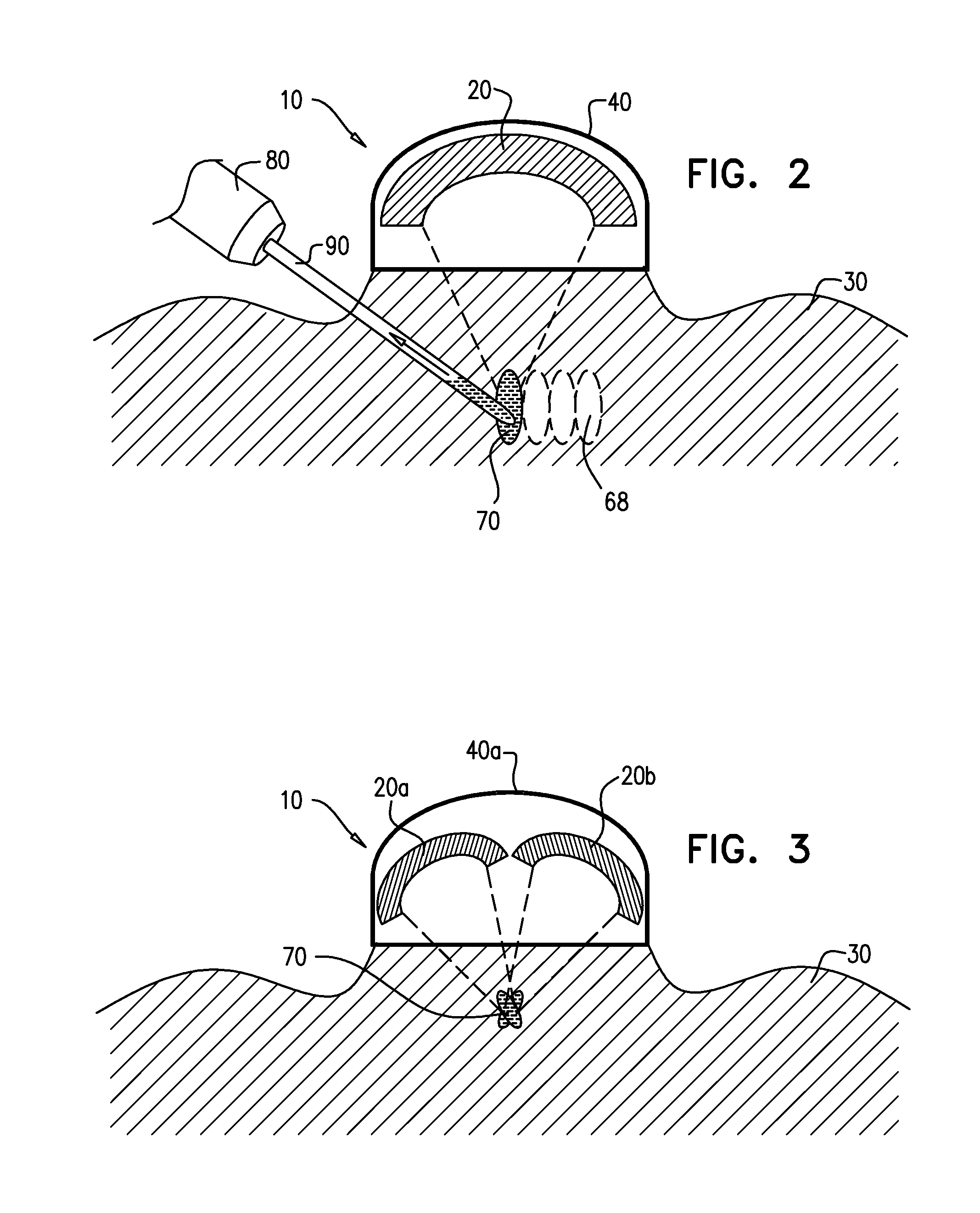 Method and device for treatment of keloids and hypertrophic scars using focused ultrasound