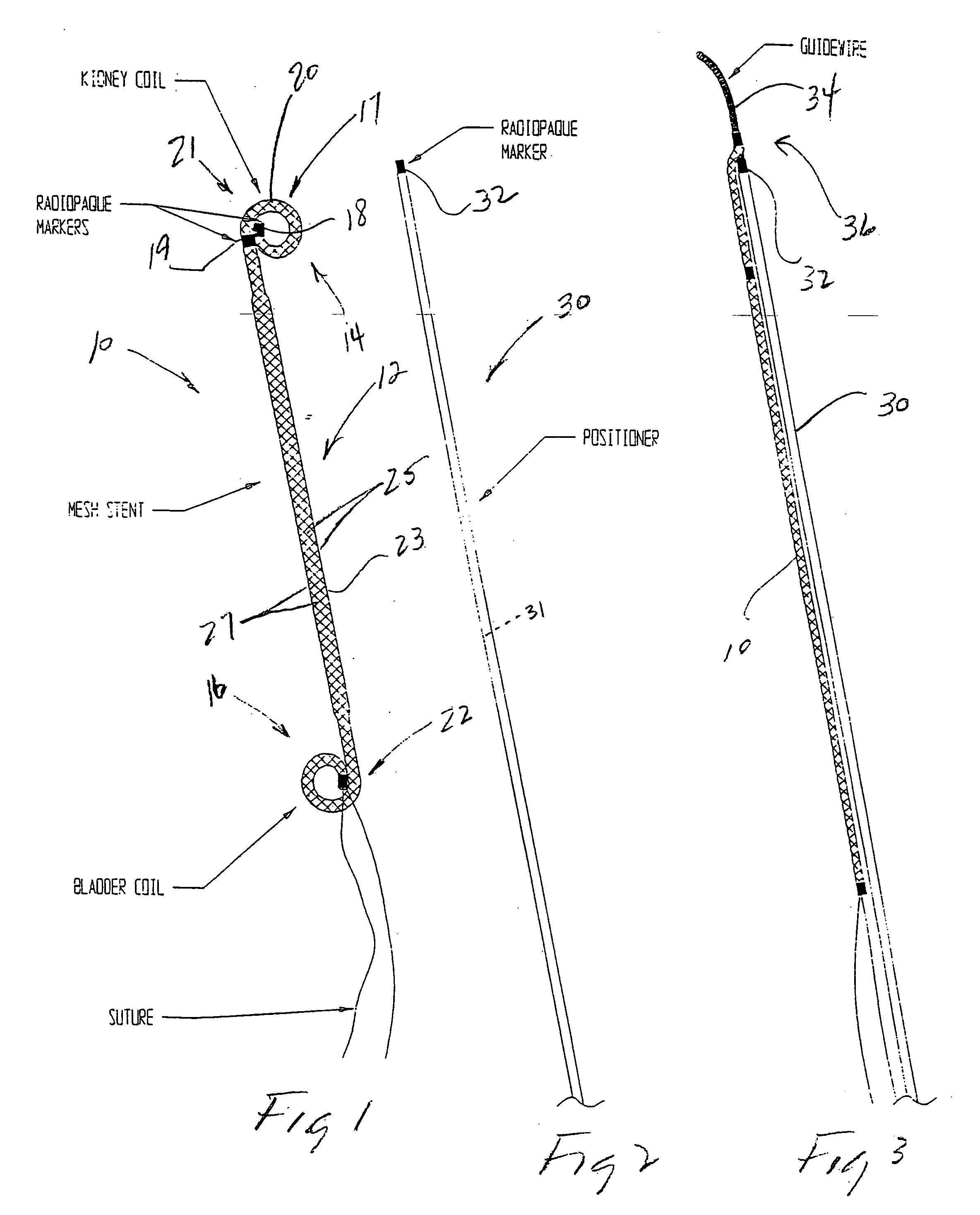 Stent delivery system and method