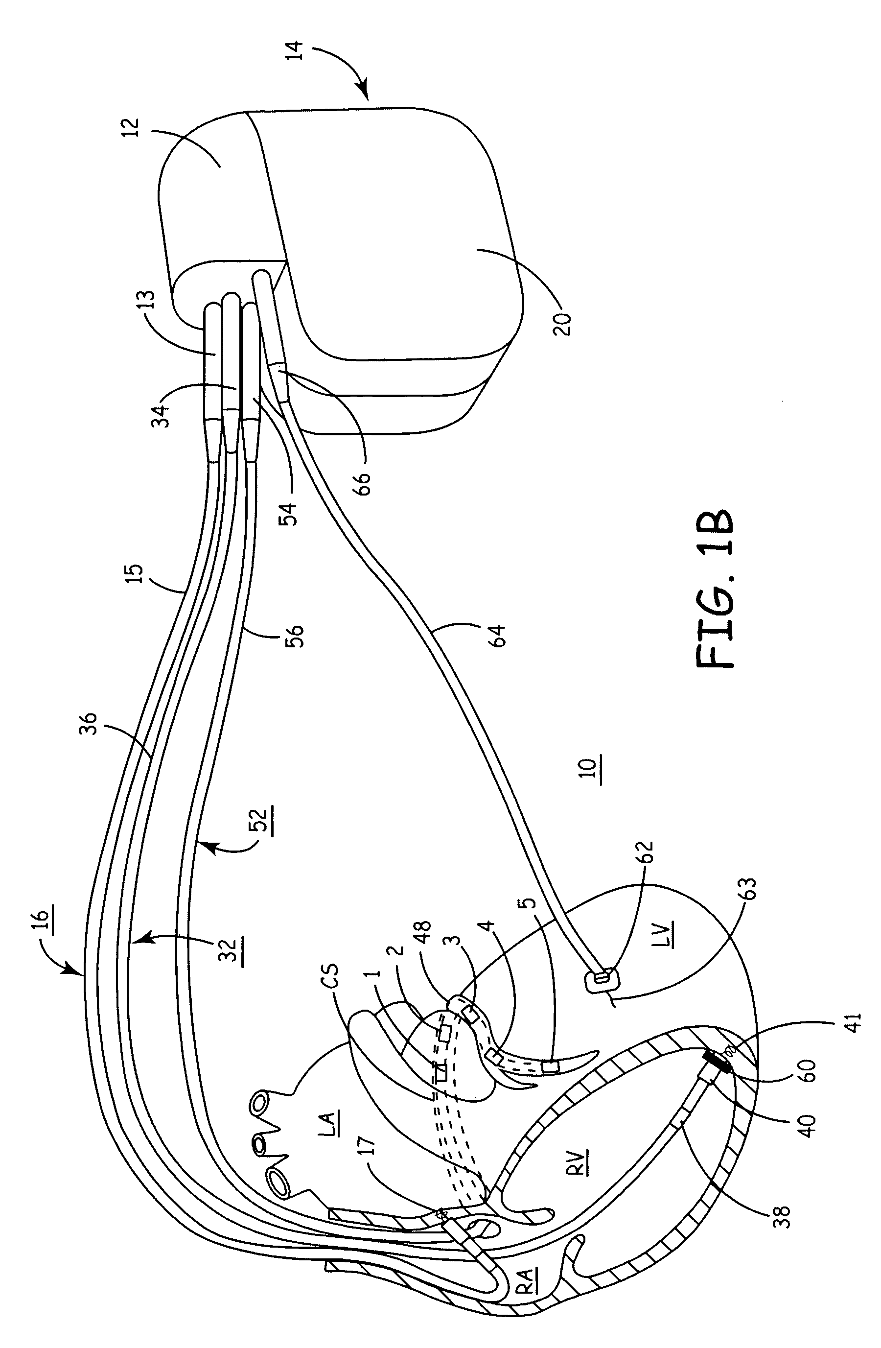 Reconfigurable, fault tolerant multiple-electrode cardiac lead systems