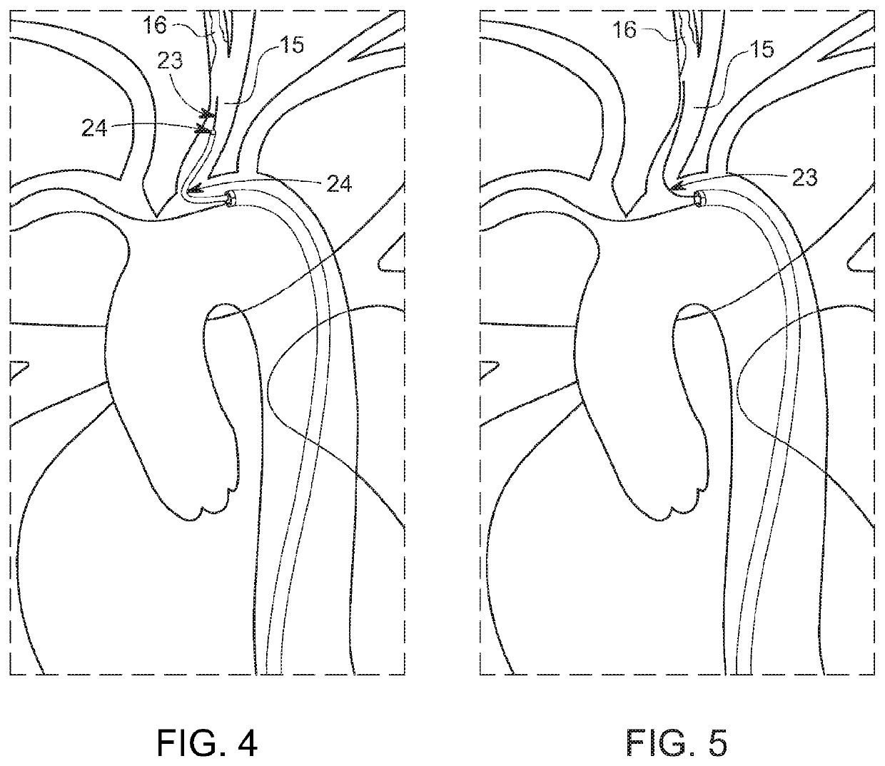 Bifurcated “Y” anchor support for coronary interventions