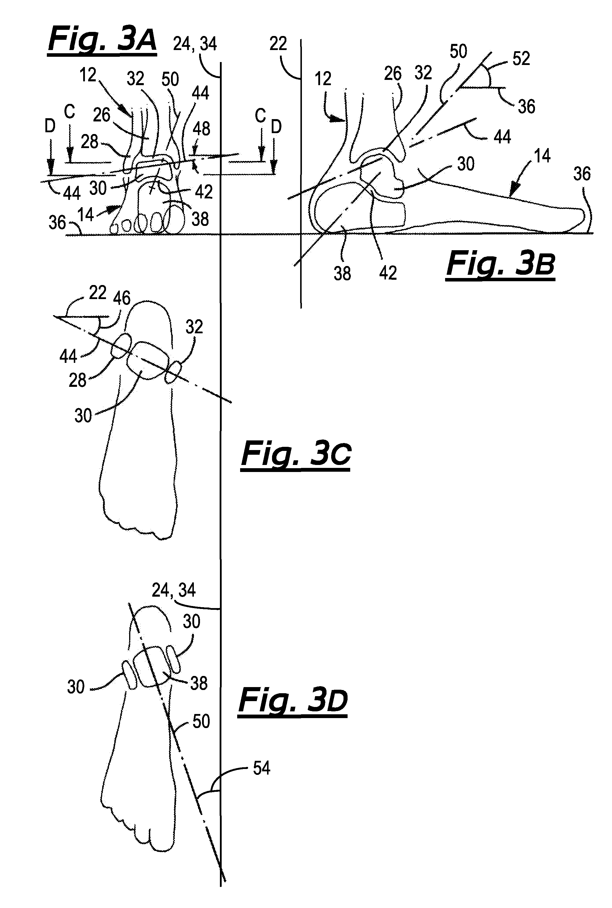 Ankle foot orthopaedic devices