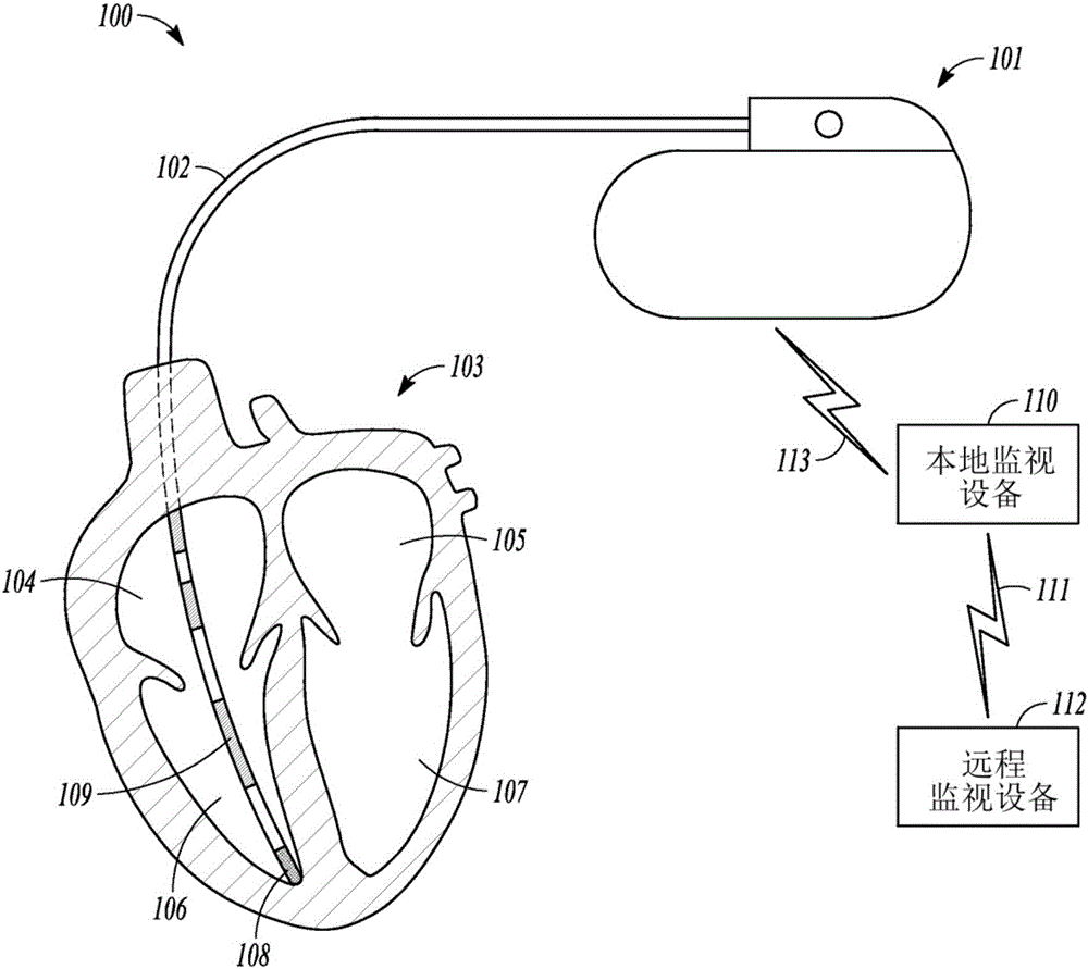 Atrial fibrillation detection using ventricular rate variability