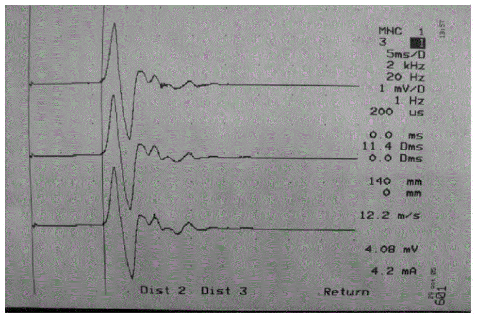 A compound preparation for treating painful diabetic neuropathy and its application