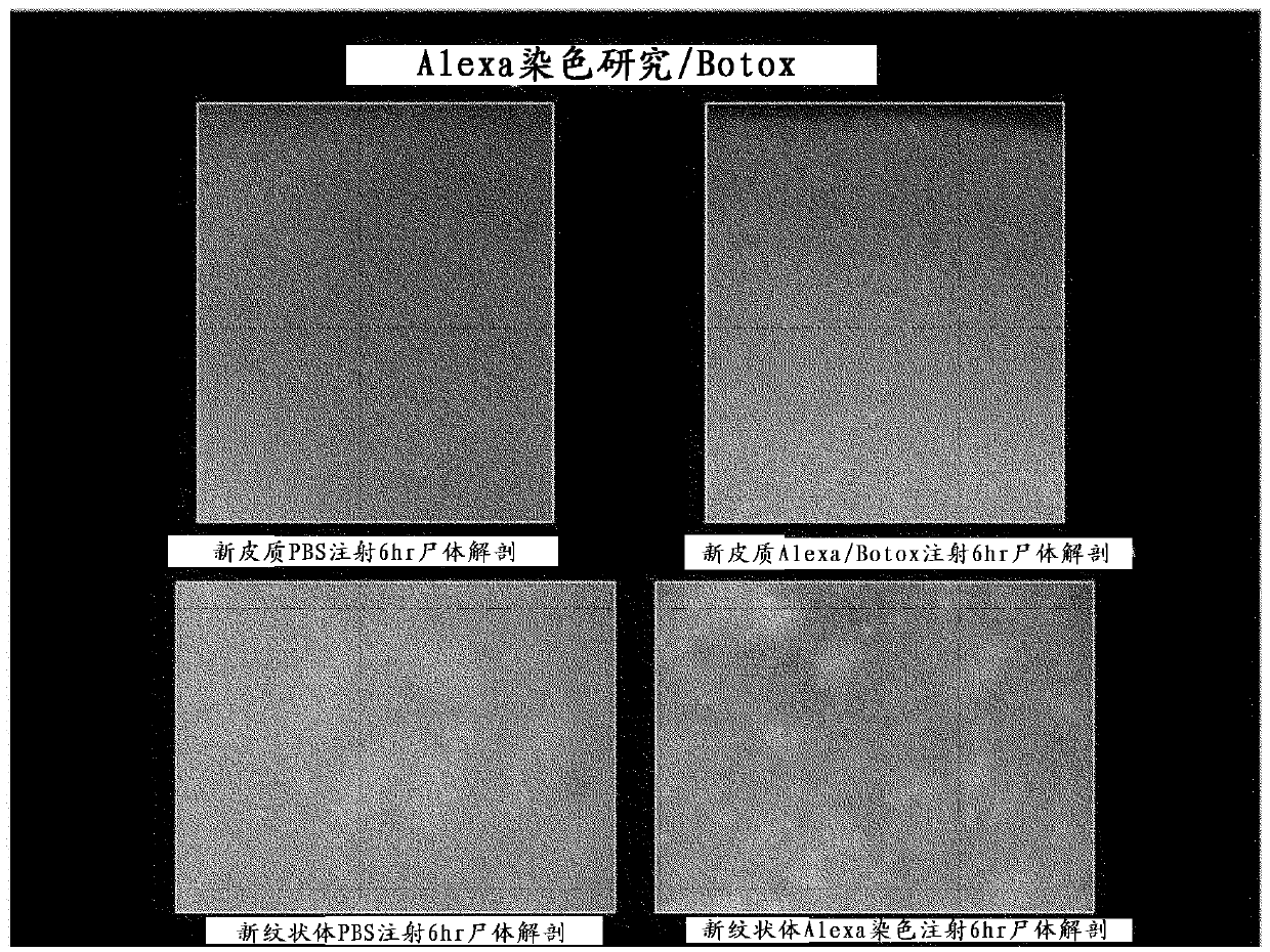 Botulinum toxin for primary disorders of mood and affect using neurotransmitter