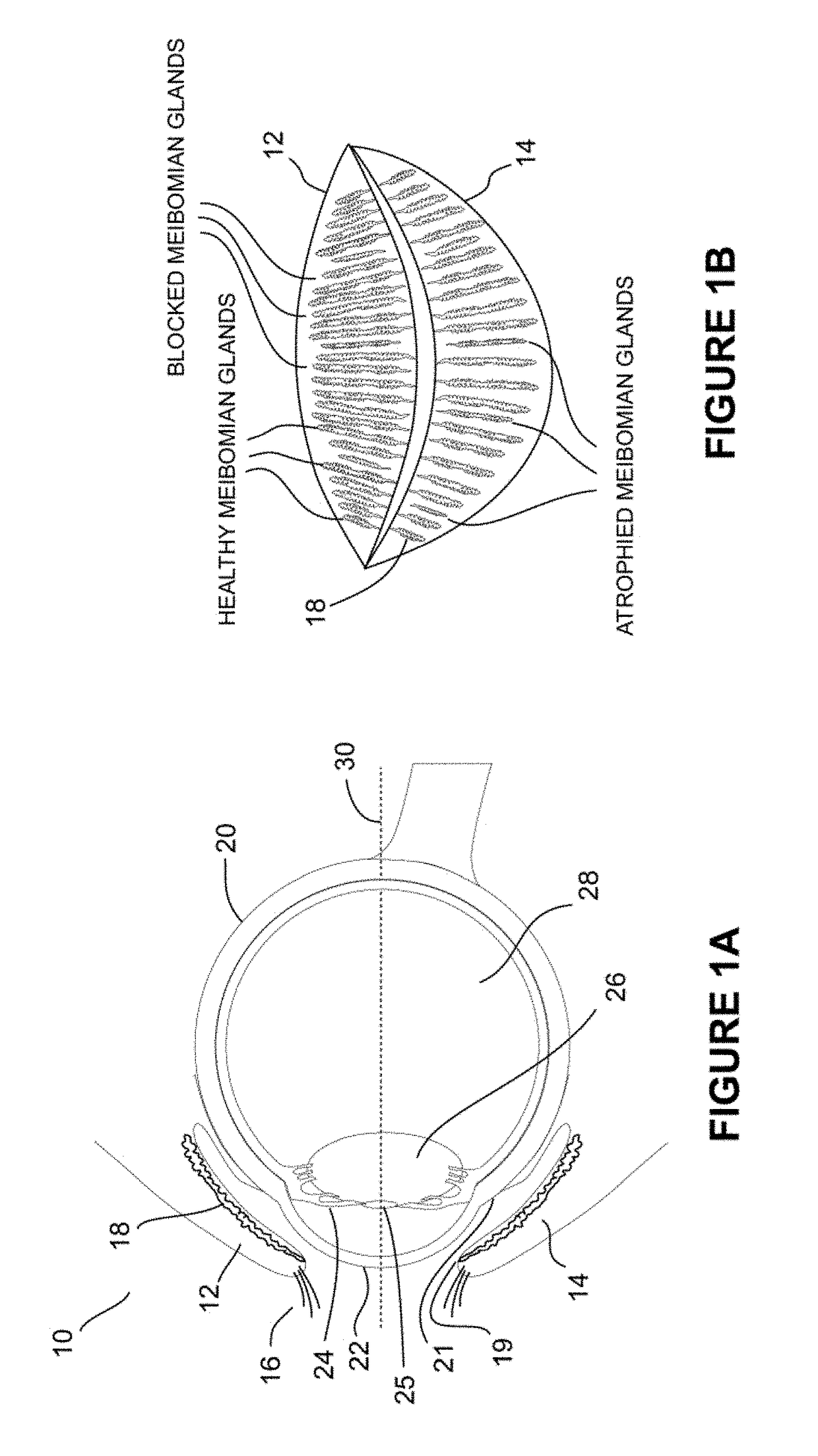 Systems and methods for the treatment of eye conditions