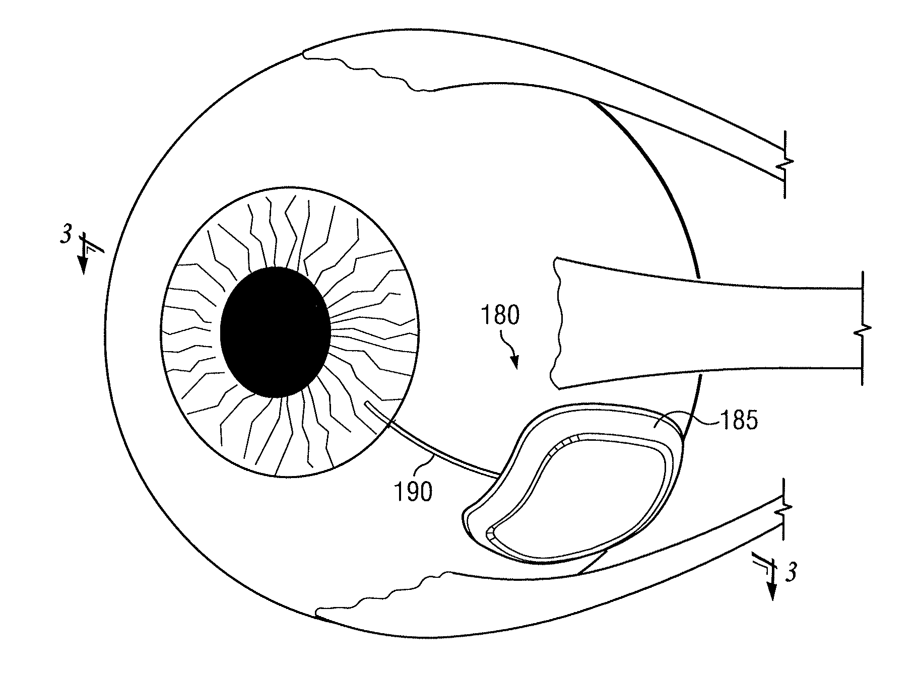 Functionally graded material tube and method for use of the same in implantation