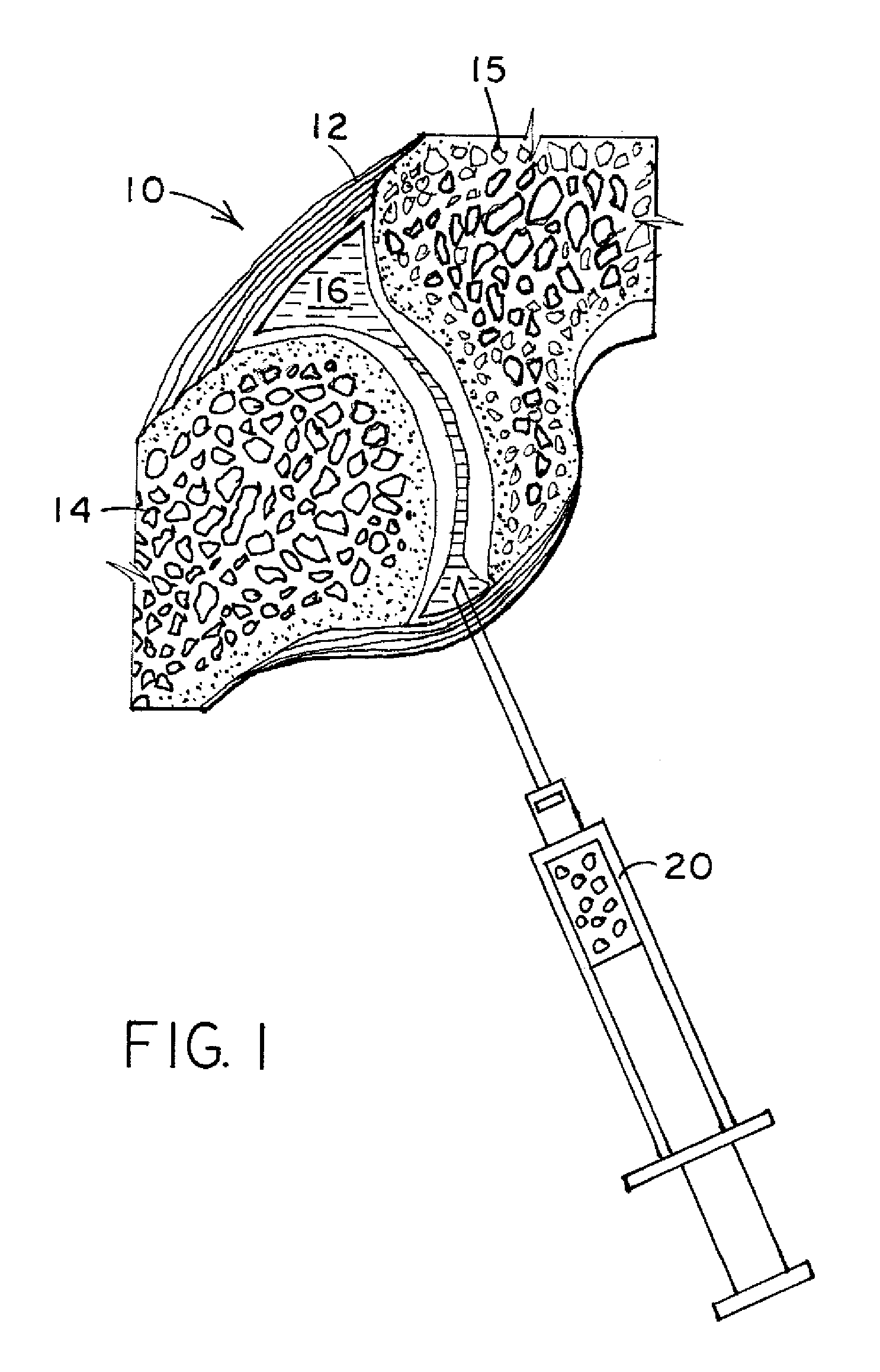 Facet joint implant and procedure