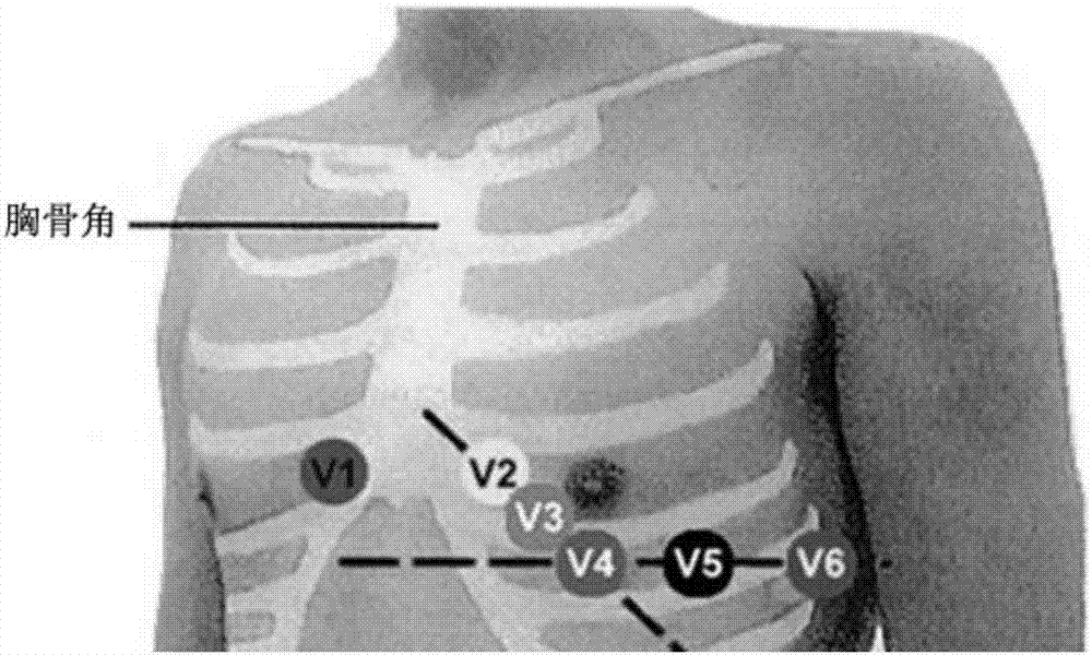 Automatic error correction electrocardiogram system and method