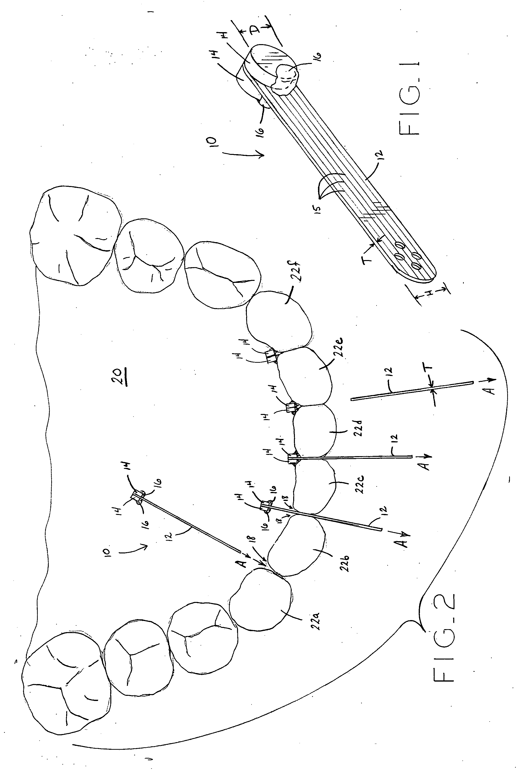 Method and apparatus for positioning an orthodontic appliance