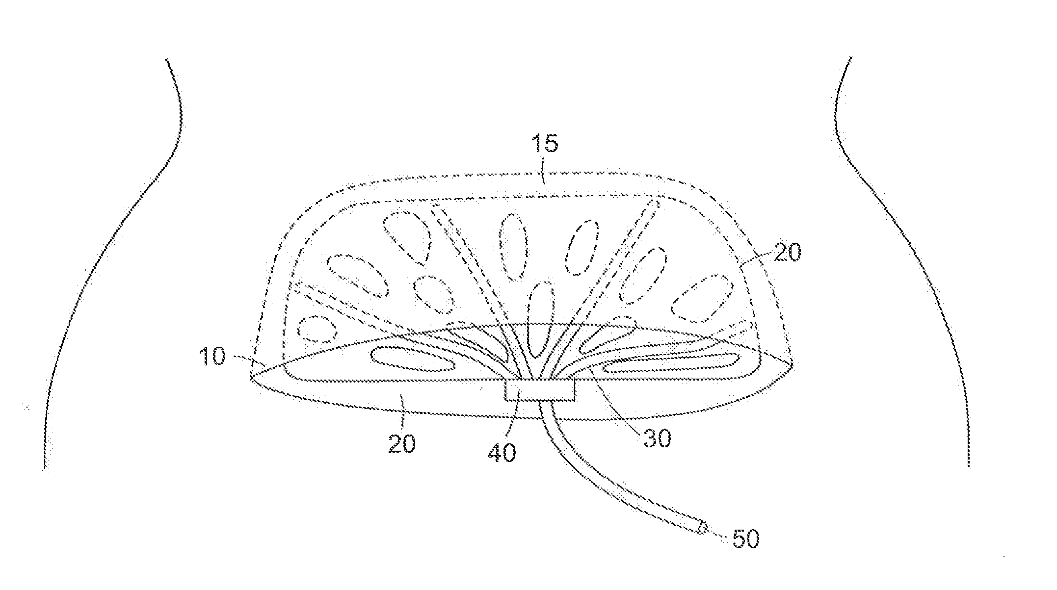 Surgical cavity drainage and closure system