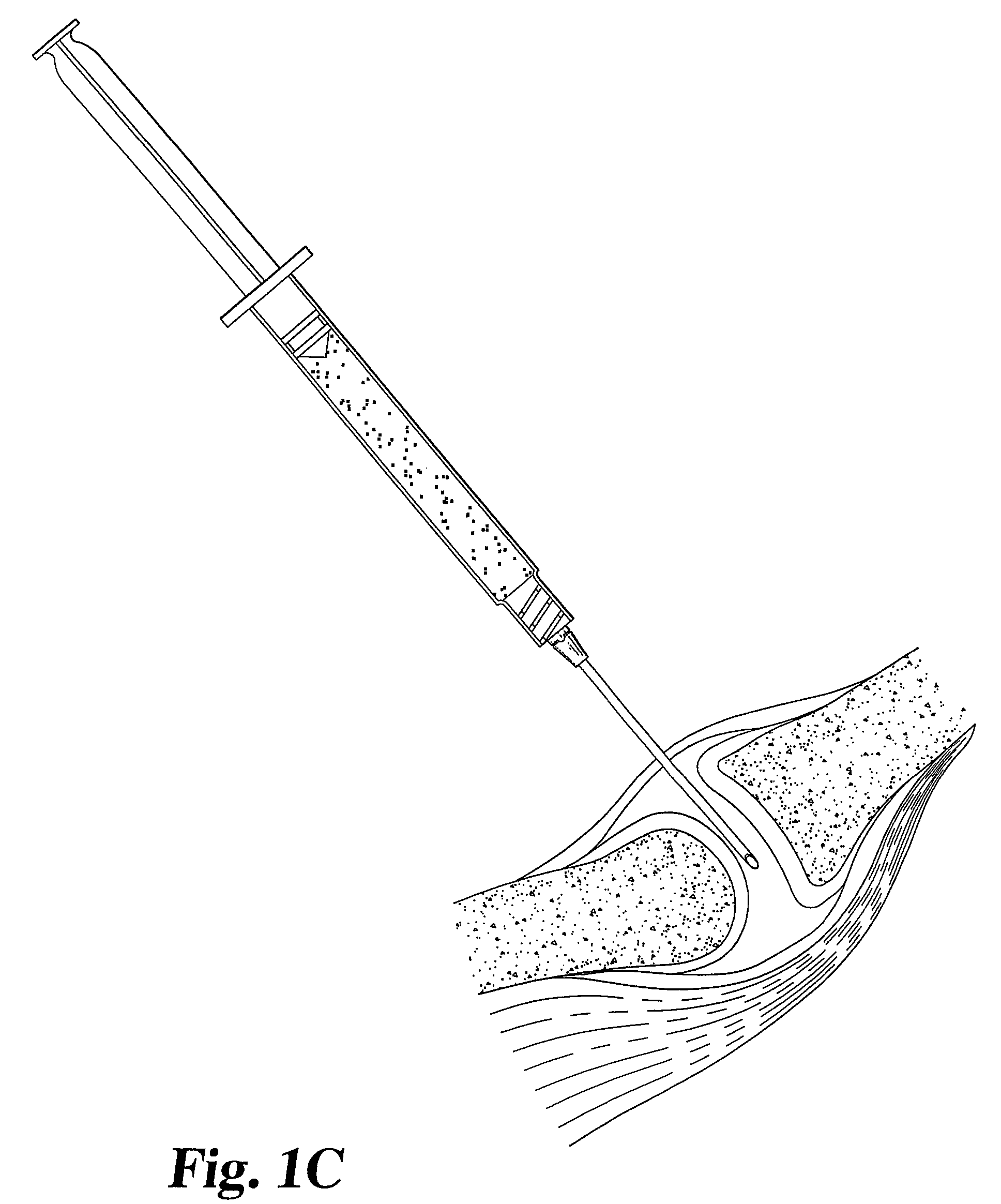 Collagen-based materials and methods for treating synovial joints