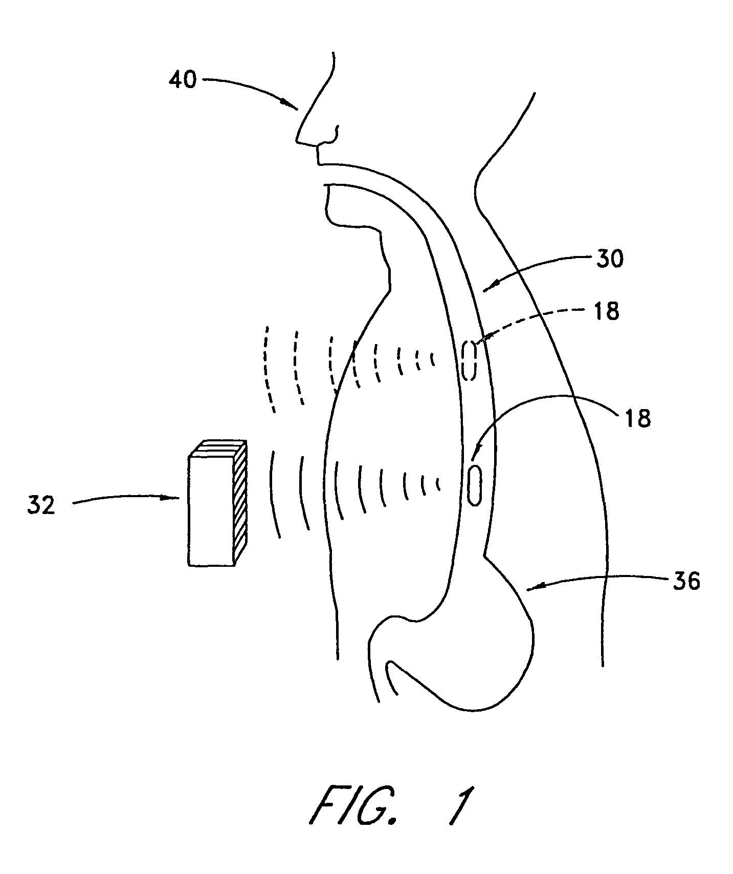 Implantable monitoring probe