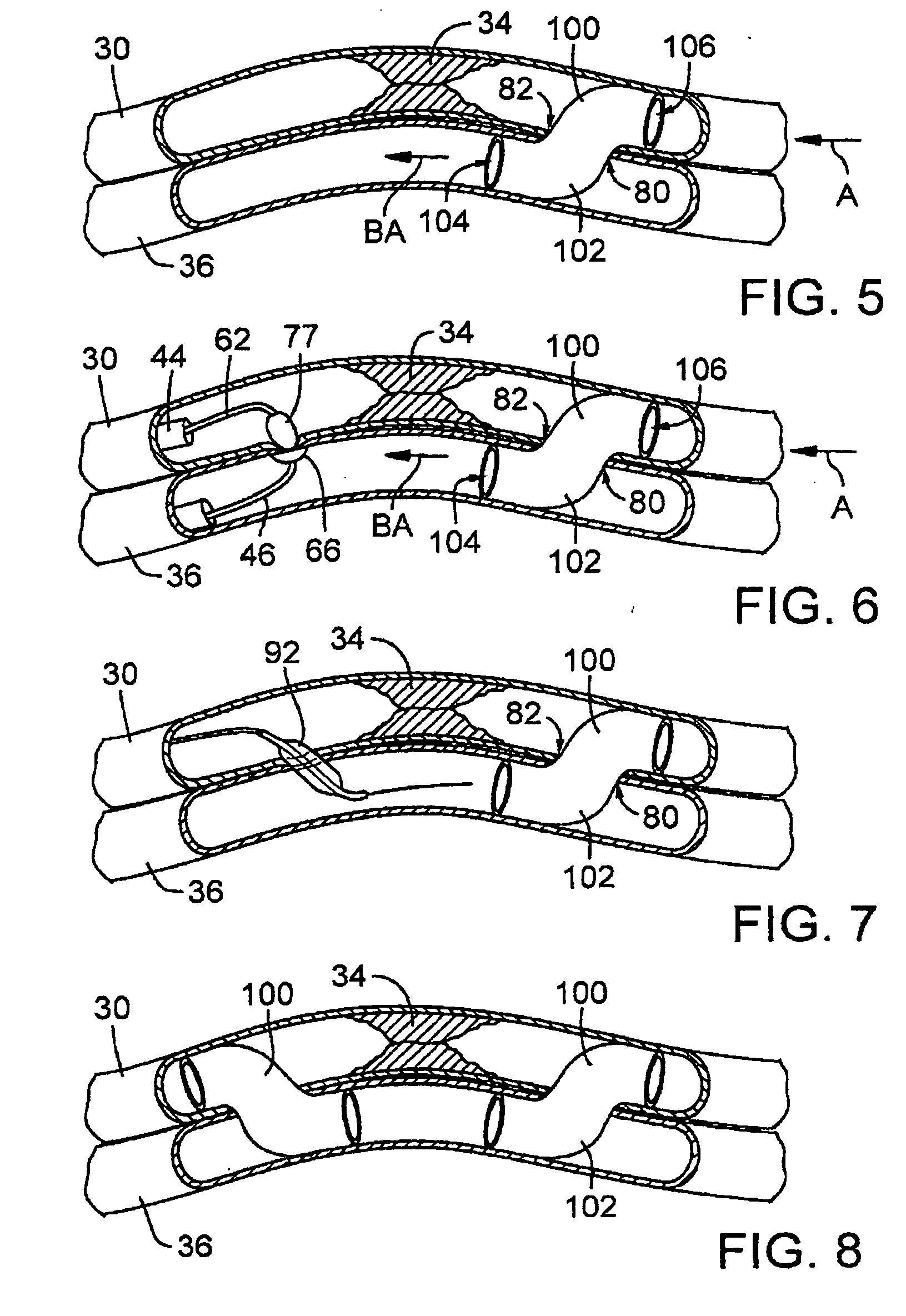 Catheter system for connecting adjacent blood vessels