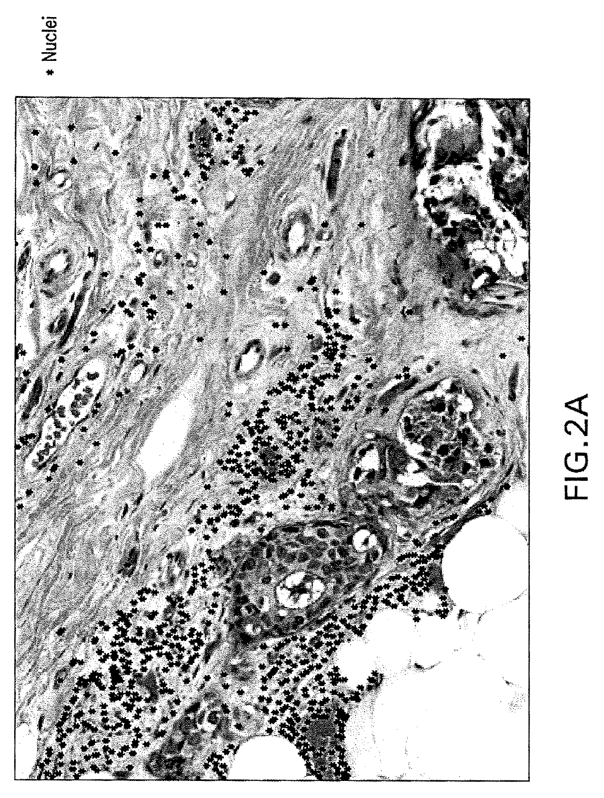 Automatic glandular and tubule detection in histological grading of breast cancer