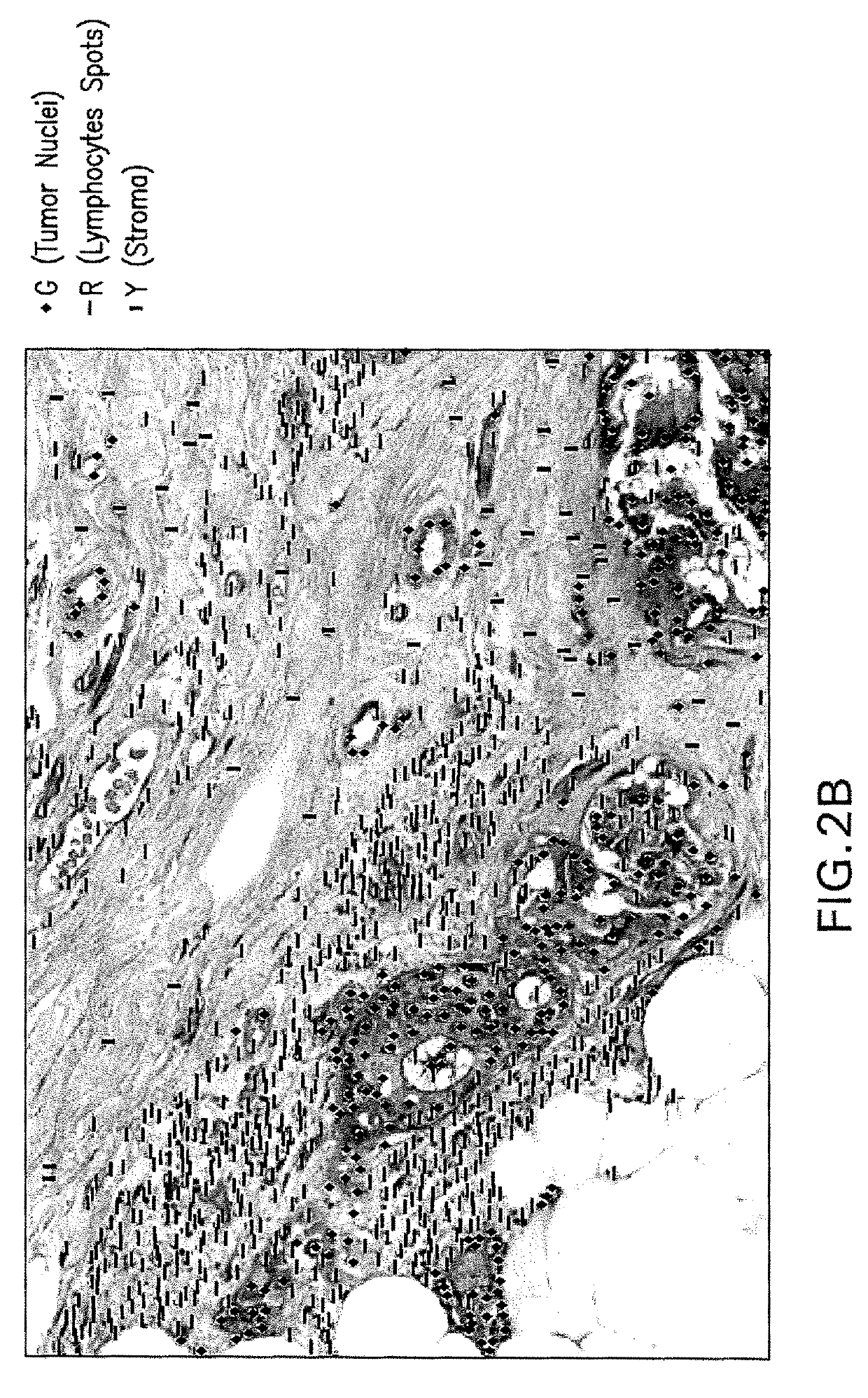 Automatic glandular and tubule detection in histological grading of breast cancer