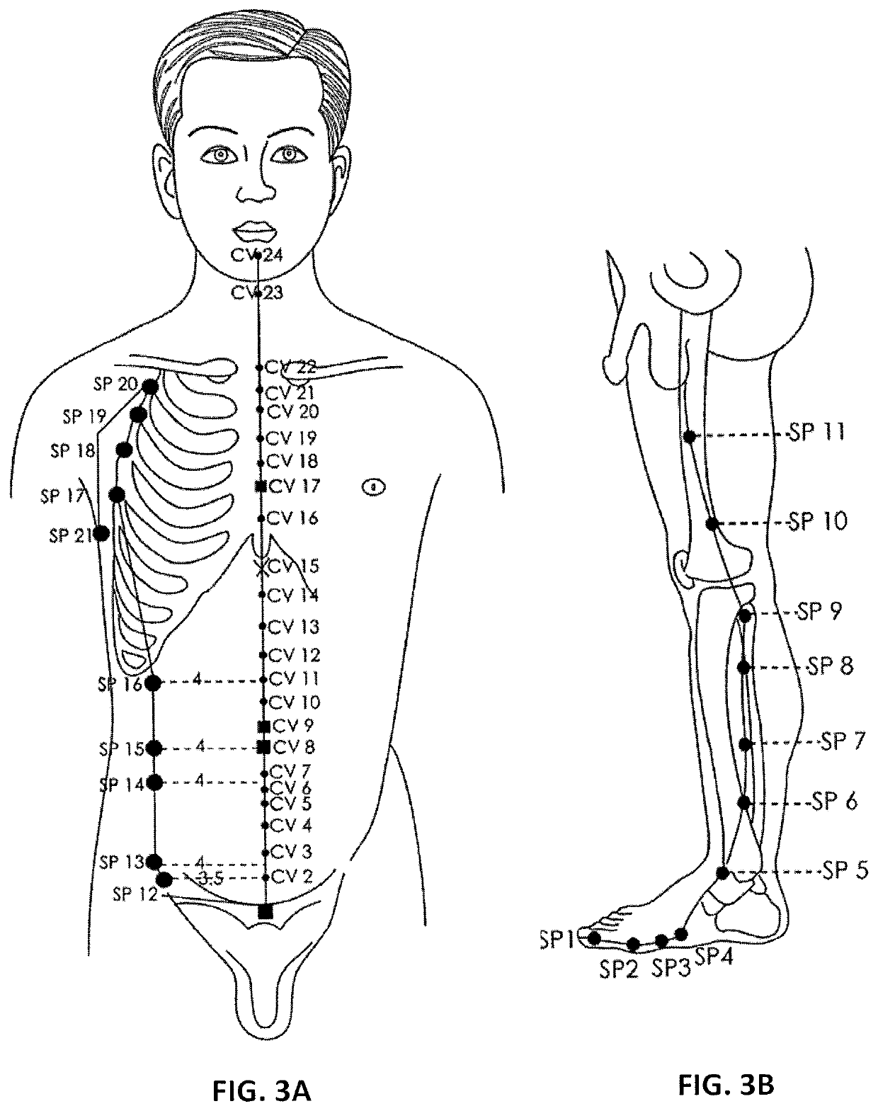 Treatment of bleeding by non-invasive stimulation