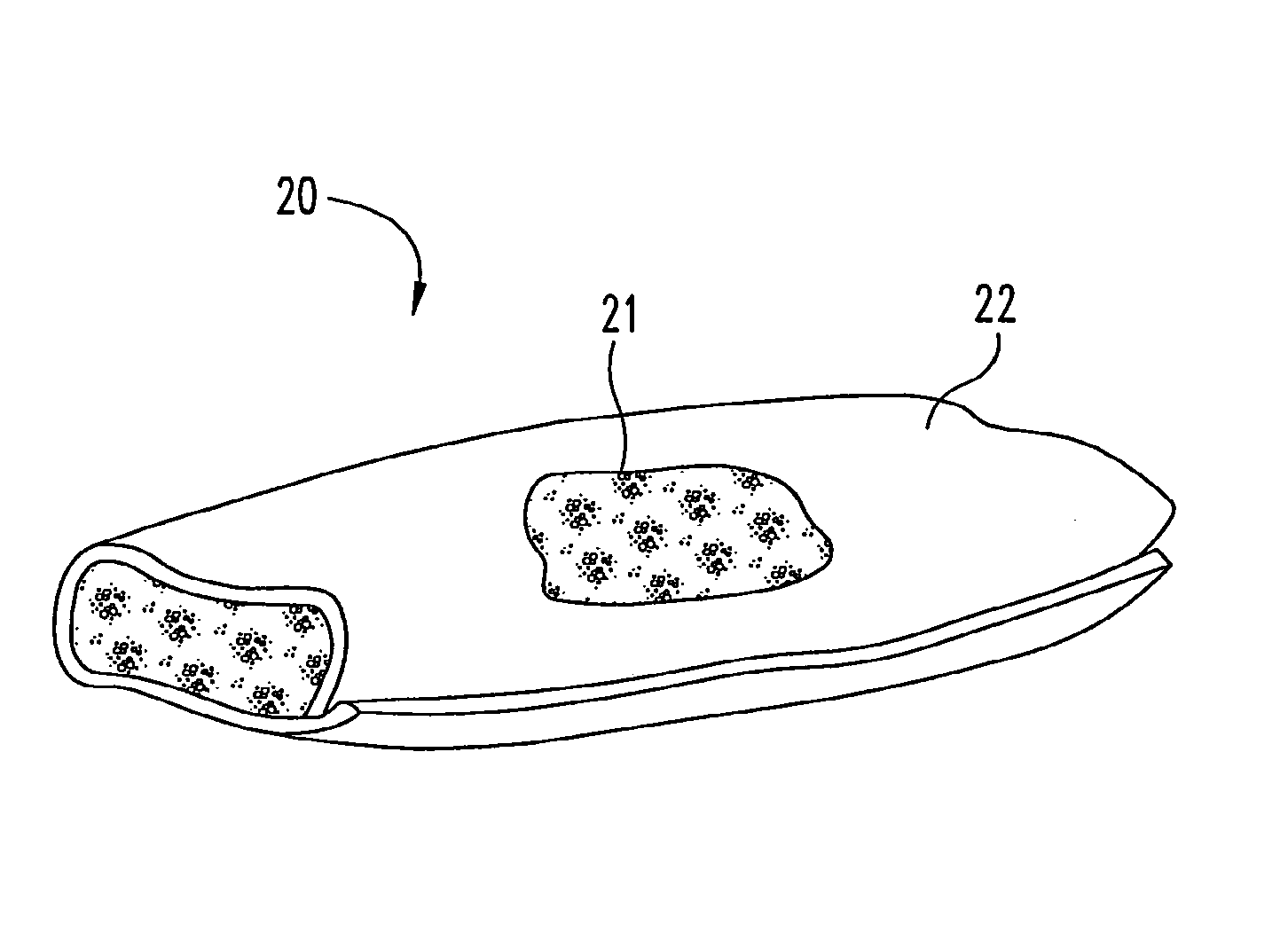 Osteogenic implants with combined implant materials and methods for same