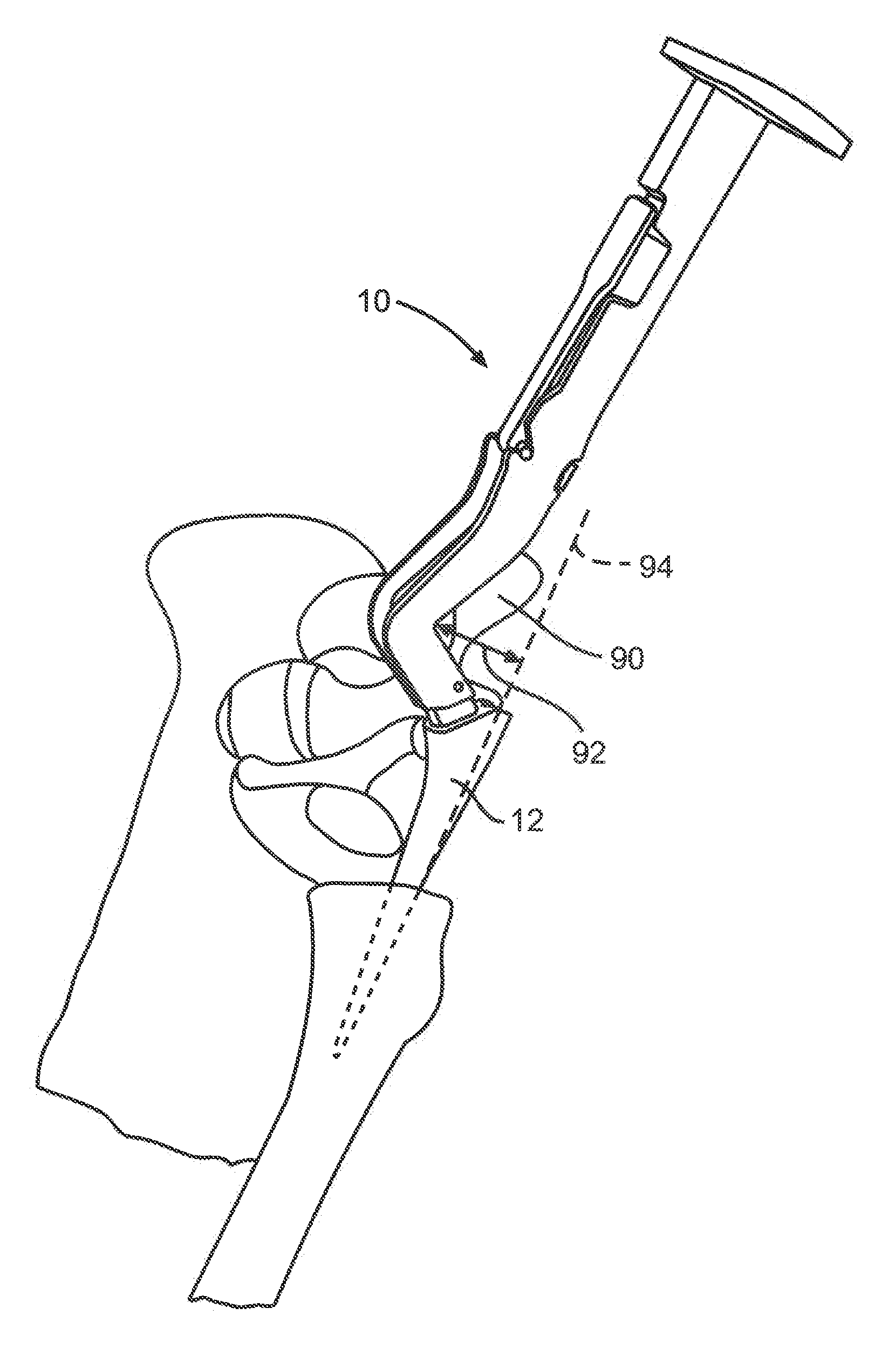 Double Offset Surgical Tool Handle Assembly To Provide Greater Offset From The Coronal Plane