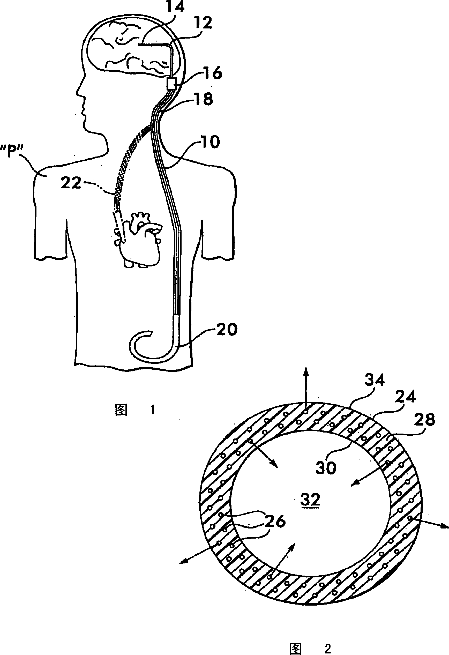 Implantable shunt or catheter enabling gradual delivery of therapeutic agents